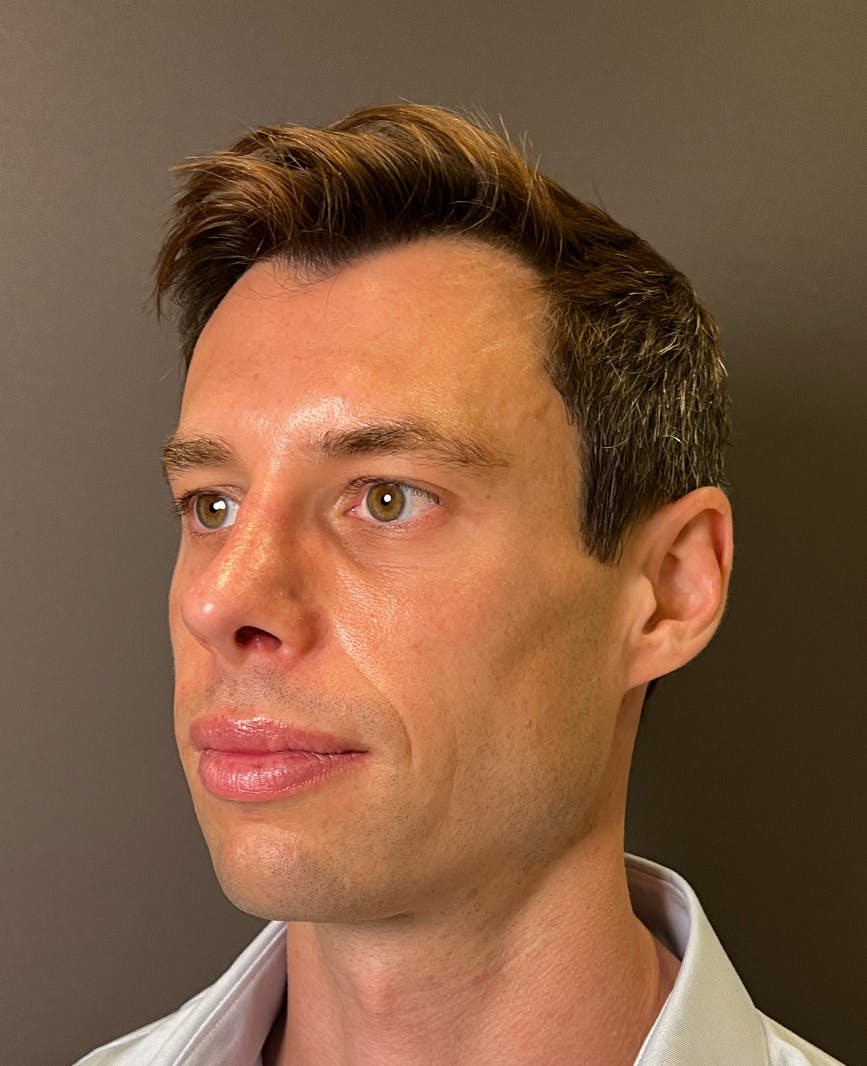 Rhinoplasty Before & After Gallery - Patient 518713 - Image 8