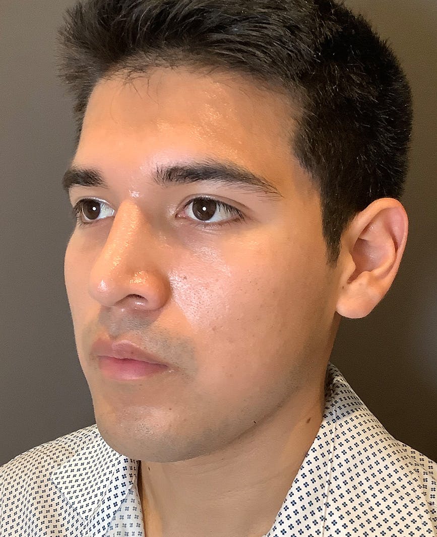 Rhinoplasty Before & After Gallery - Patient 314911 - Image 8