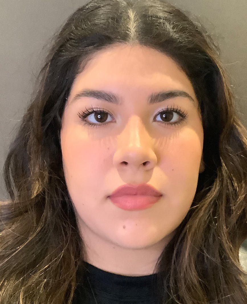 Rhinoplasty Before & After Gallery - Patient 273713 - Image 6