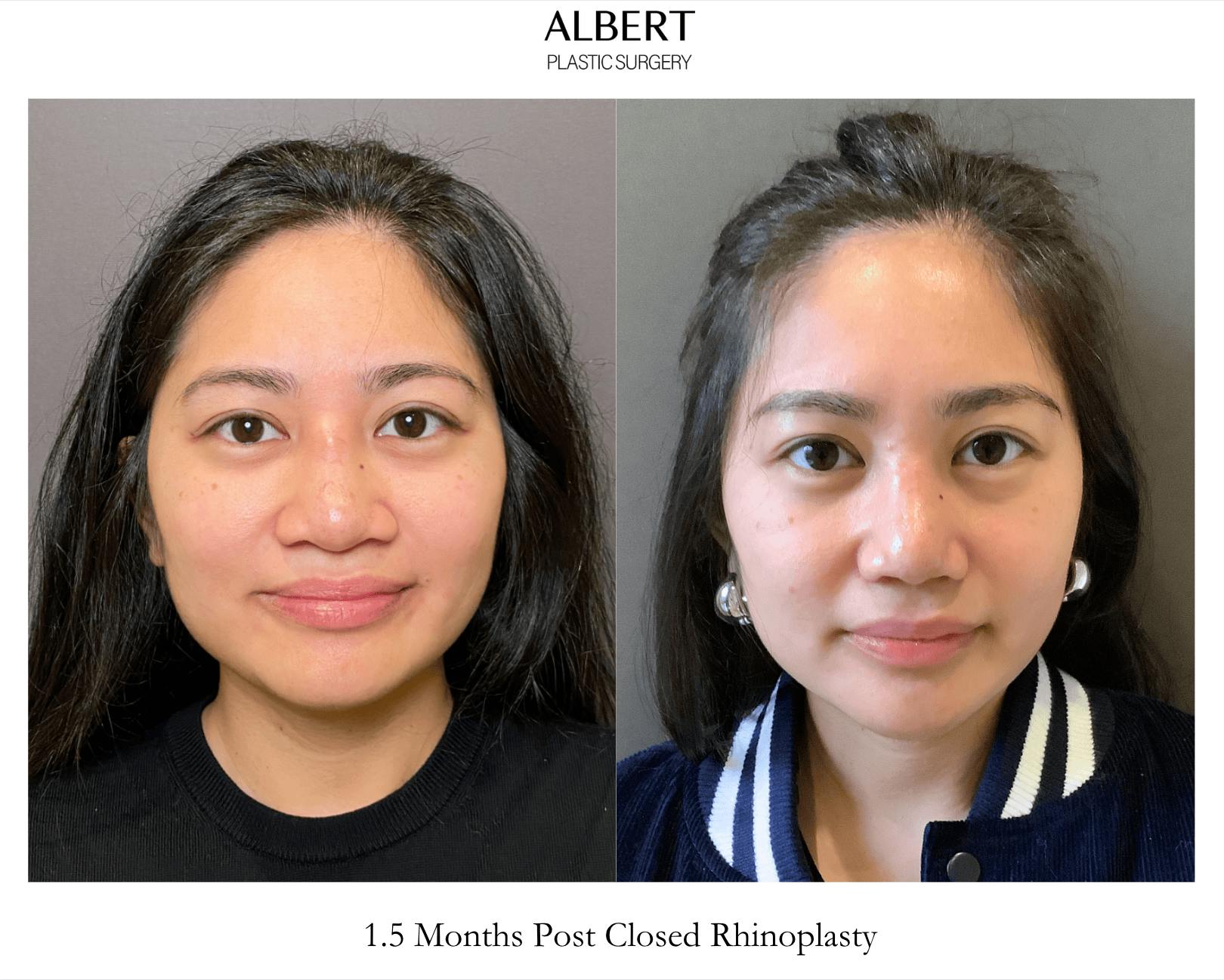 Revision Rhinoplasty Before & After Gallery - Patient 192574 - Image 2