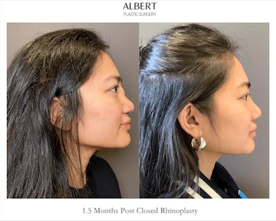 Revision Rhinoplasty Before & After Gallery - Patient 192574 - Image 1