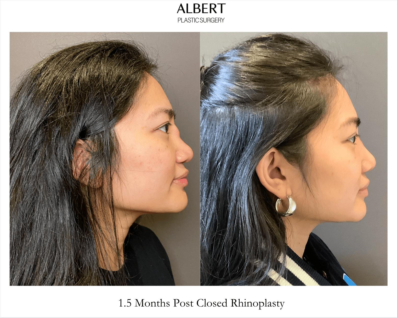 Revision Rhinoplasty Before & After Gallery - Patient 192574 - Image 1
