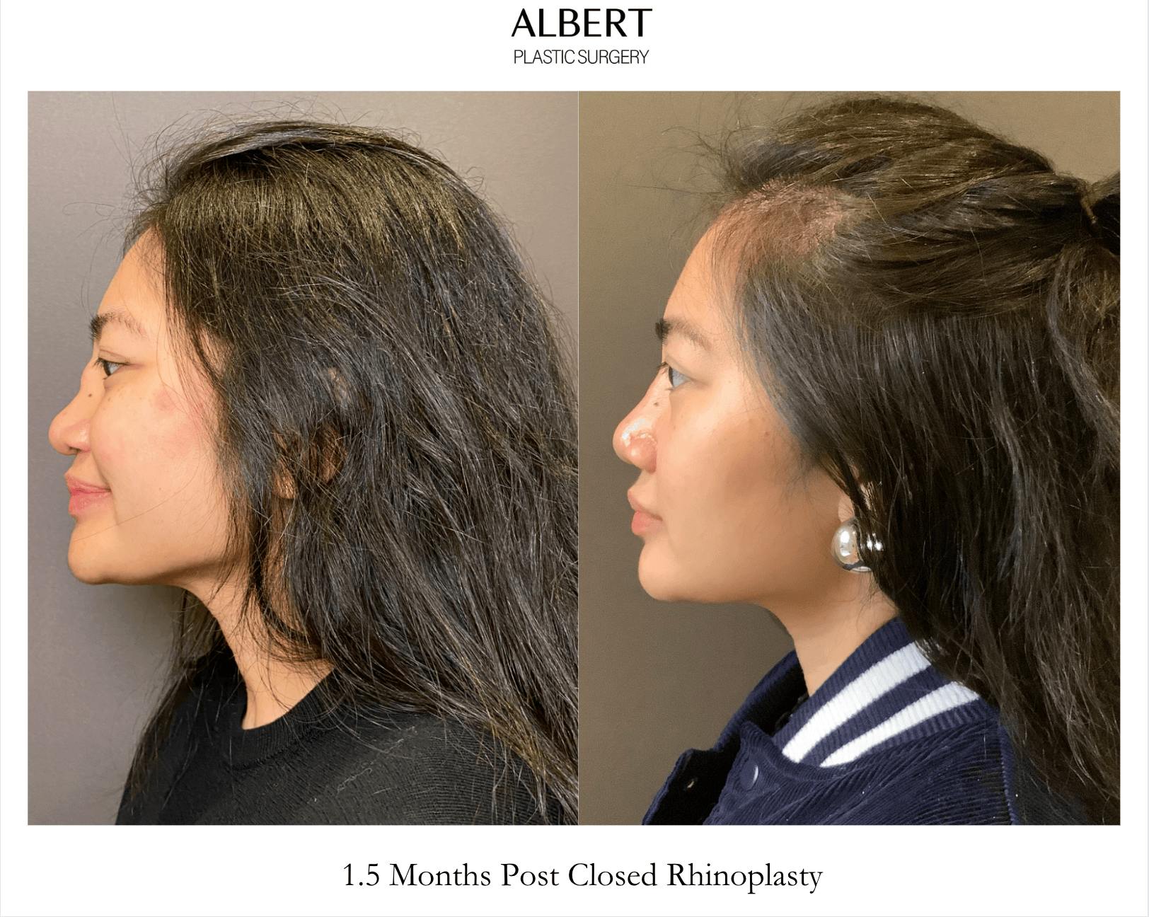 Revision Rhinoplasty Before & After Gallery - Patient 192574 - Image 3