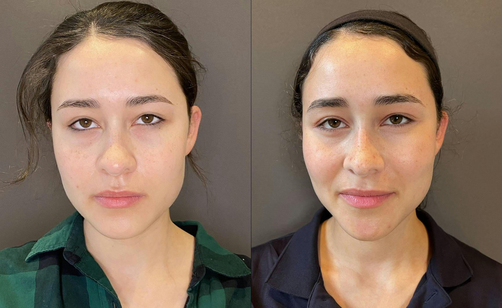 Eyelid Surgery Before & After Gallery - Patient 339497 - Image 1