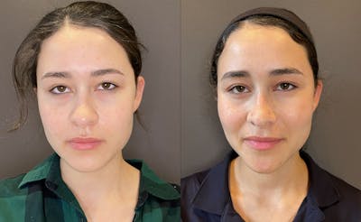 Eyelid Surgery Before & After Gallery - Patient 339497 - Image 1