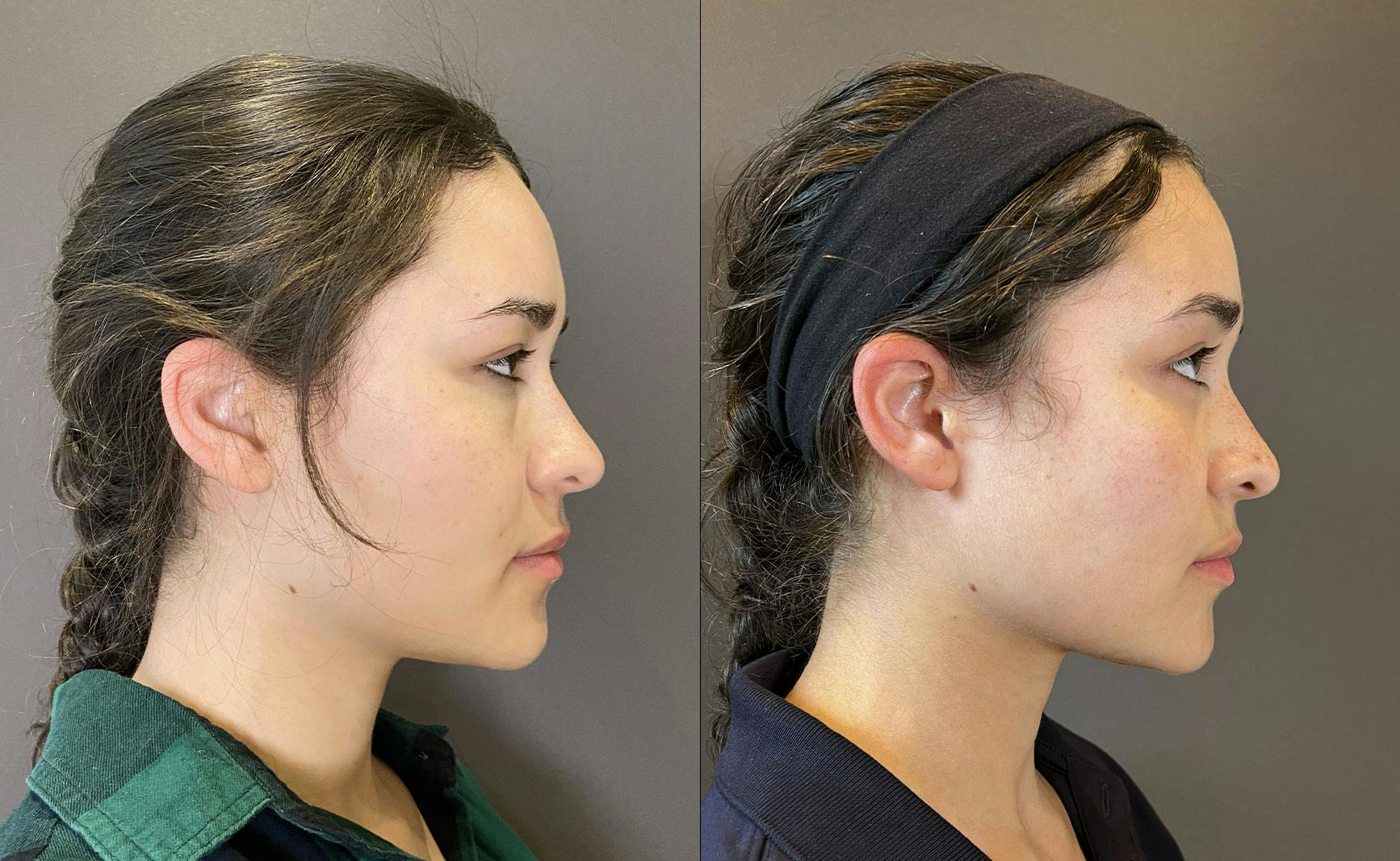 Eyelid Surgery Before & After Gallery - Patient 339497 - Image 4