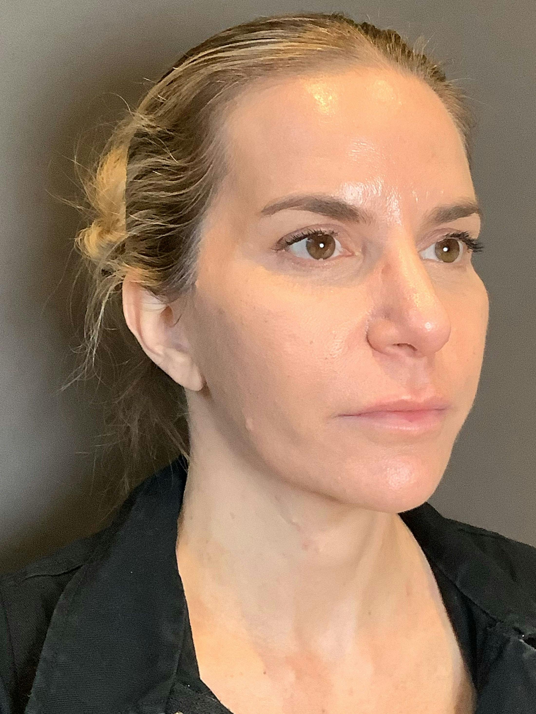 Facelifts / Necklift Before & After Gallery - Patient 290459 - Image 2