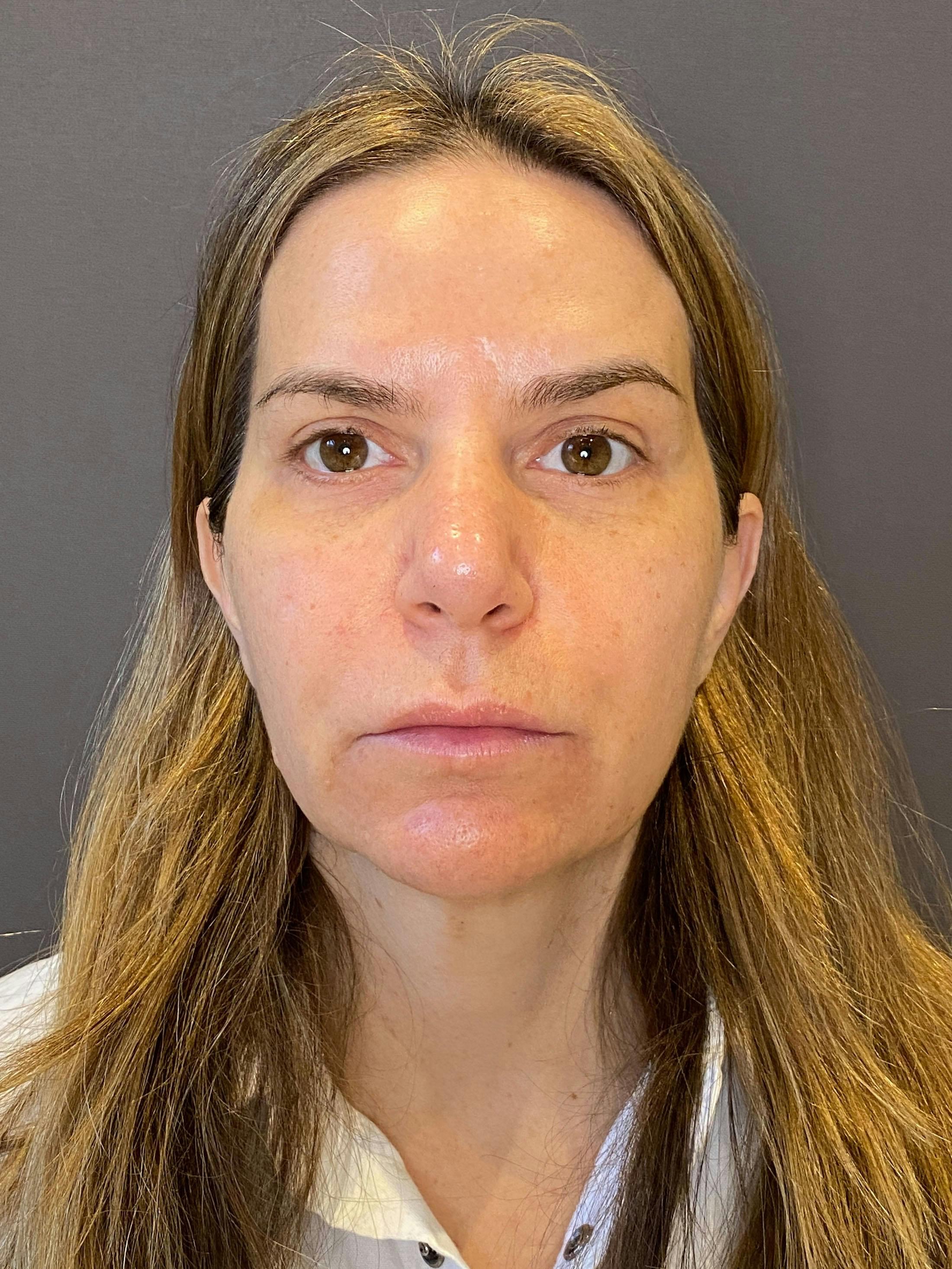 Facelifts / Necklift Before & After Gallery - Patient 290459 - Image 3