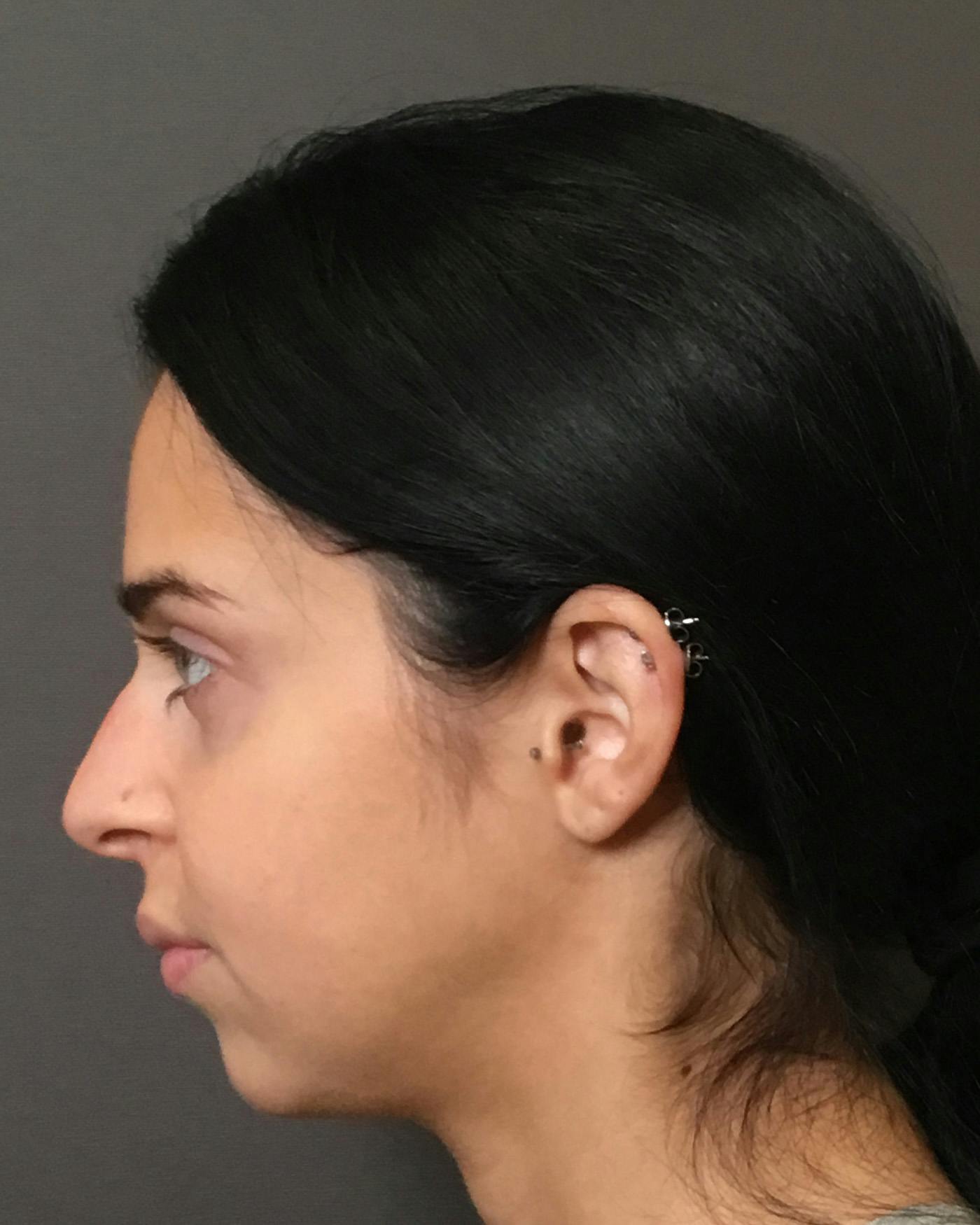Rhinoplasty Before & After Gallery - Patient 265222 - Image 11