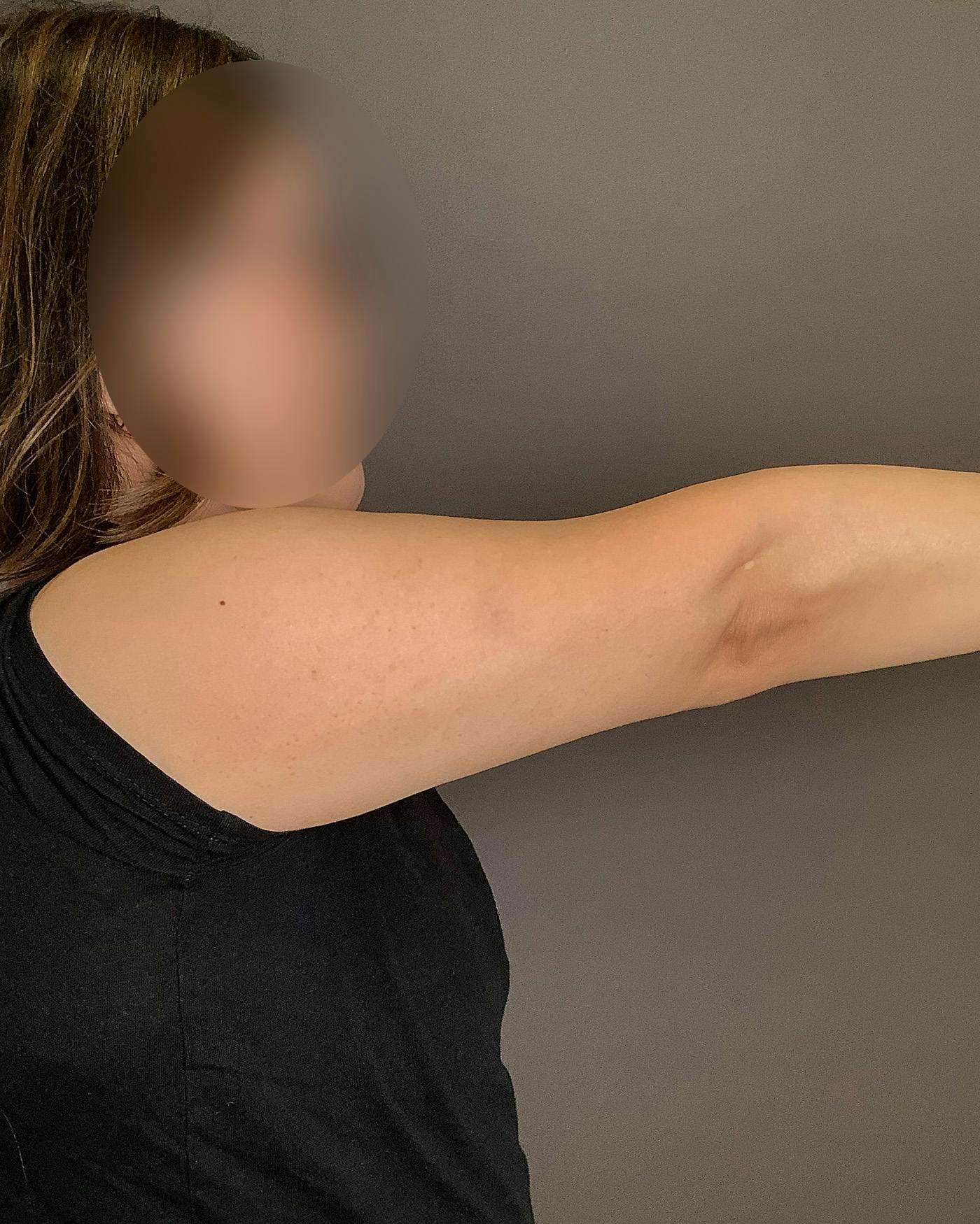 Liposuction Before & After Gallery - Patient 154945 - Image 2