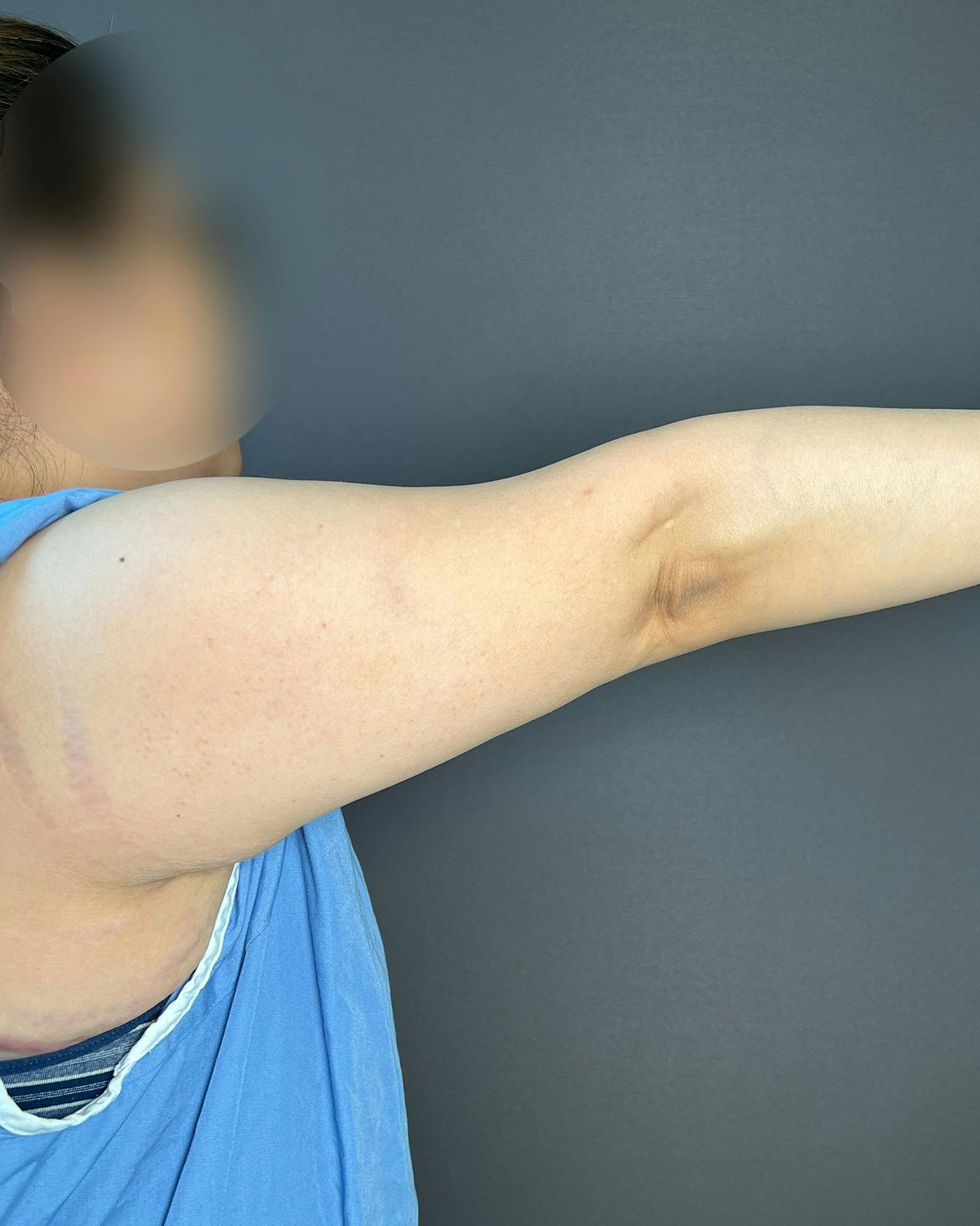 Liposuction Before & After Gallery - Patient 154945 - Image 1