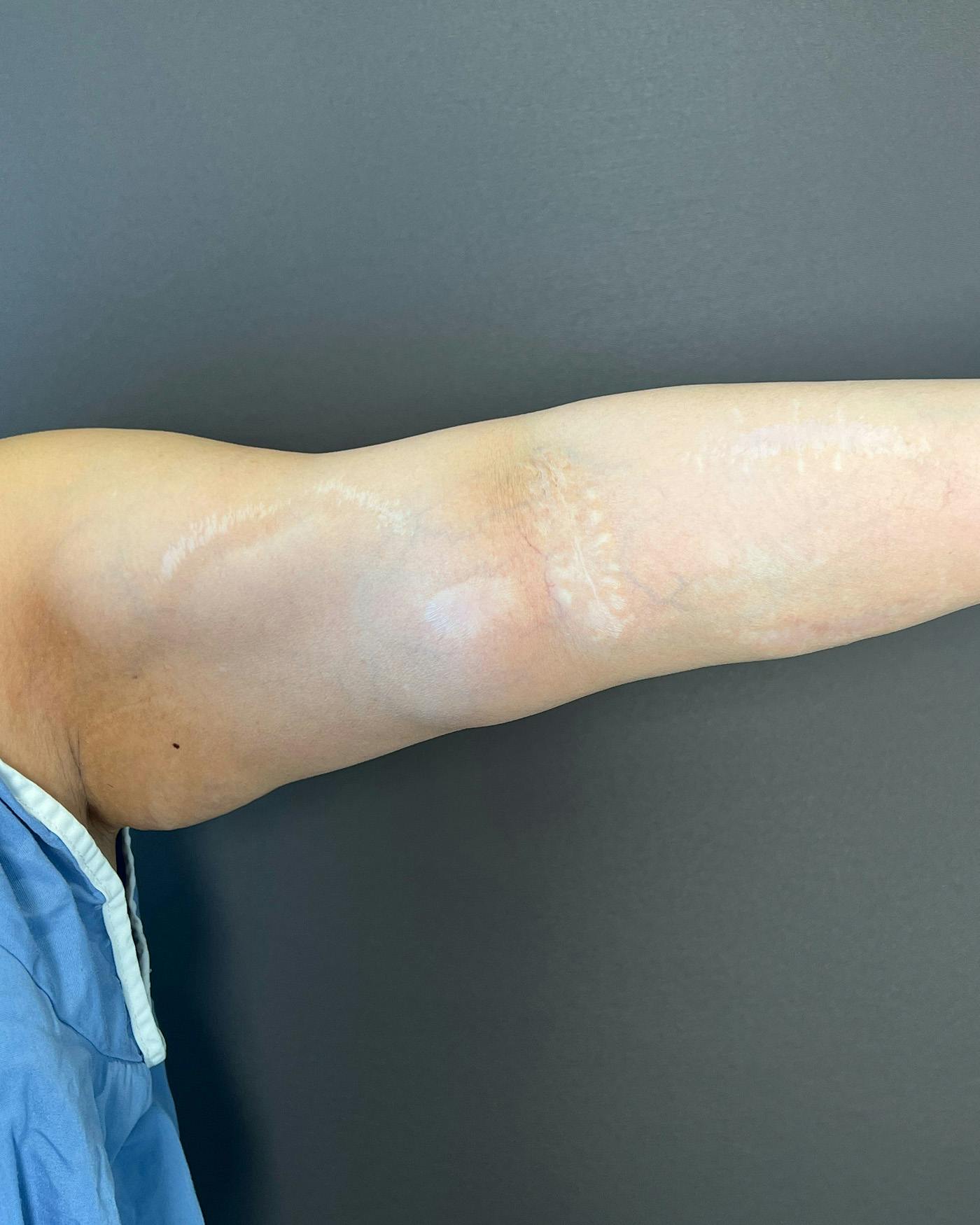 Liposuction Before & After Gallery - Patient 154945 - Image 3