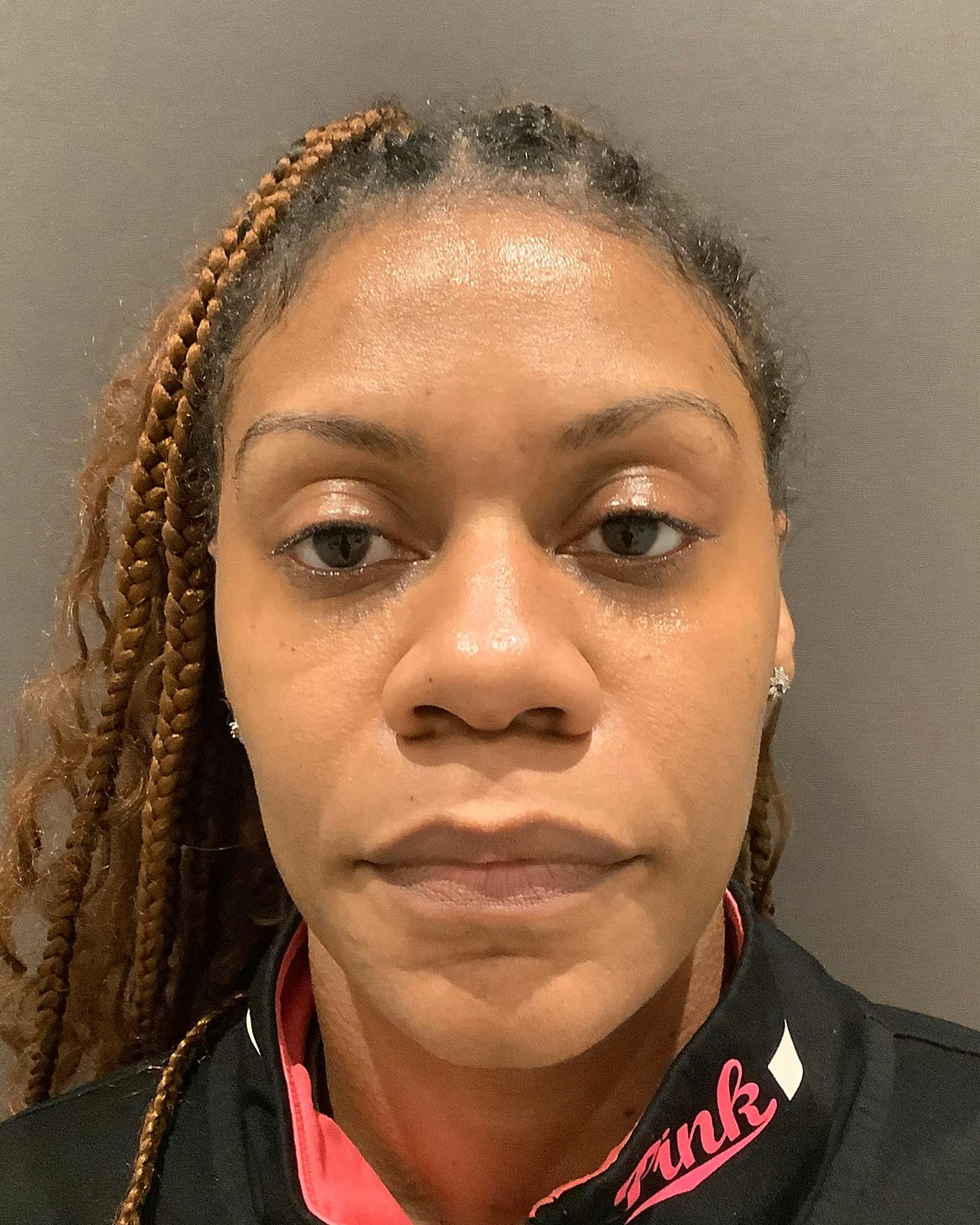 Rhinoplasty Before & After Gallery - Patient 245867 - Image 3