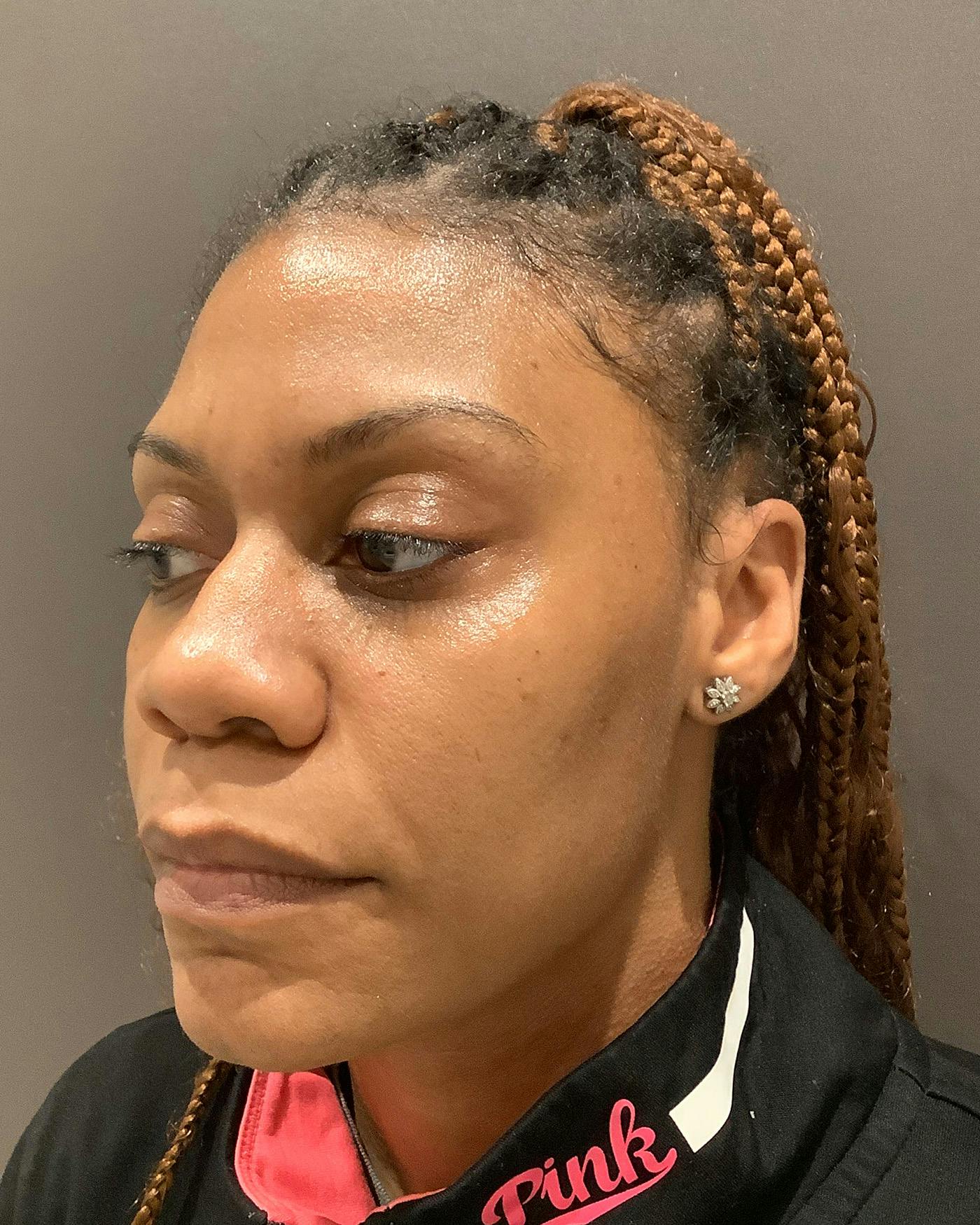 Rhinoplasty Before & After Gallery - Patient 245867 - Image 5