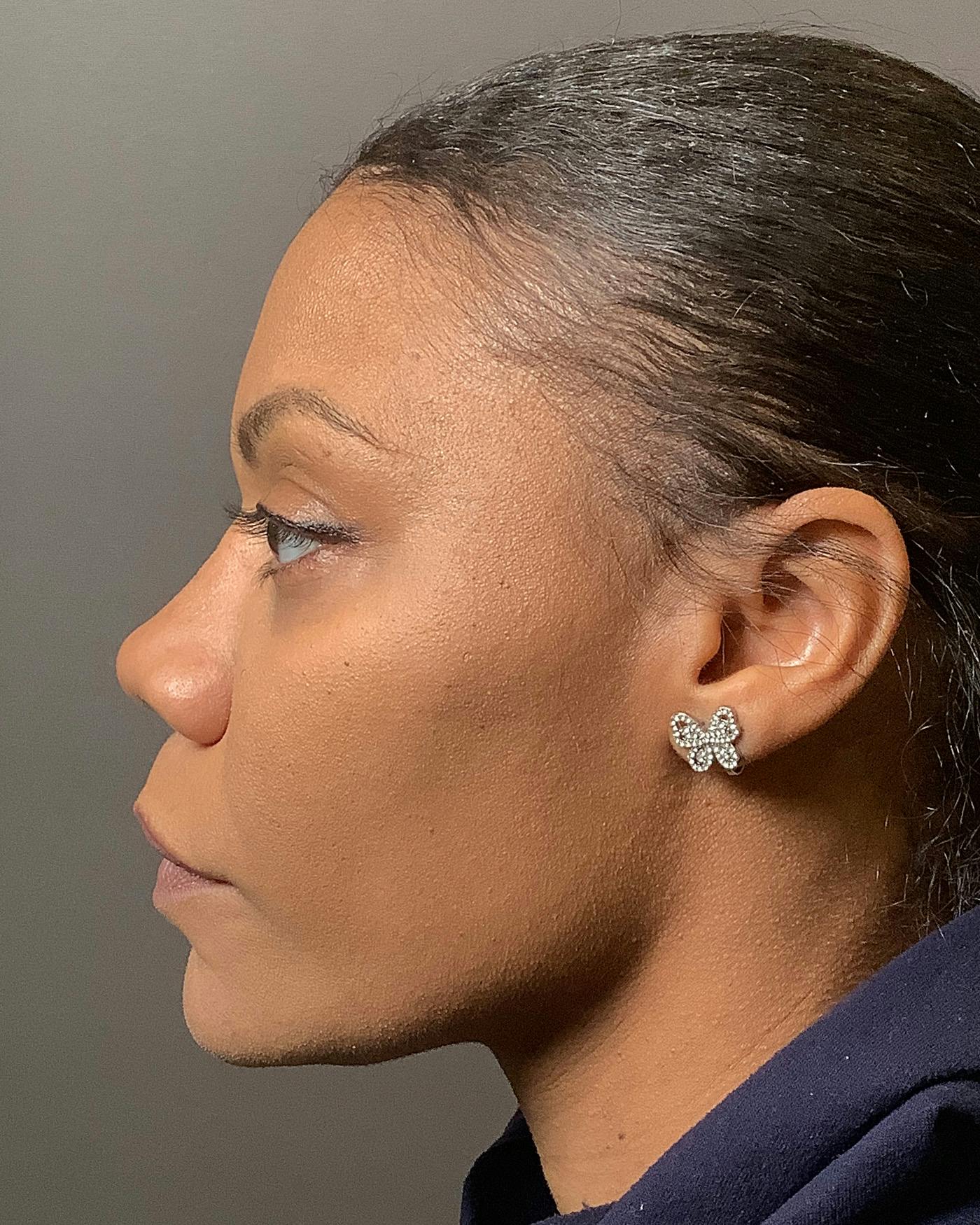 Rhinoplasty Before & After Gallery - Patient 245867 - Image 8