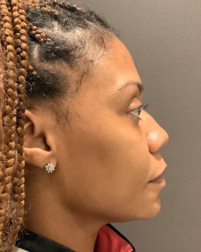 Rhinoplasty Before & After Gallery - Patient 245867 - Image 1