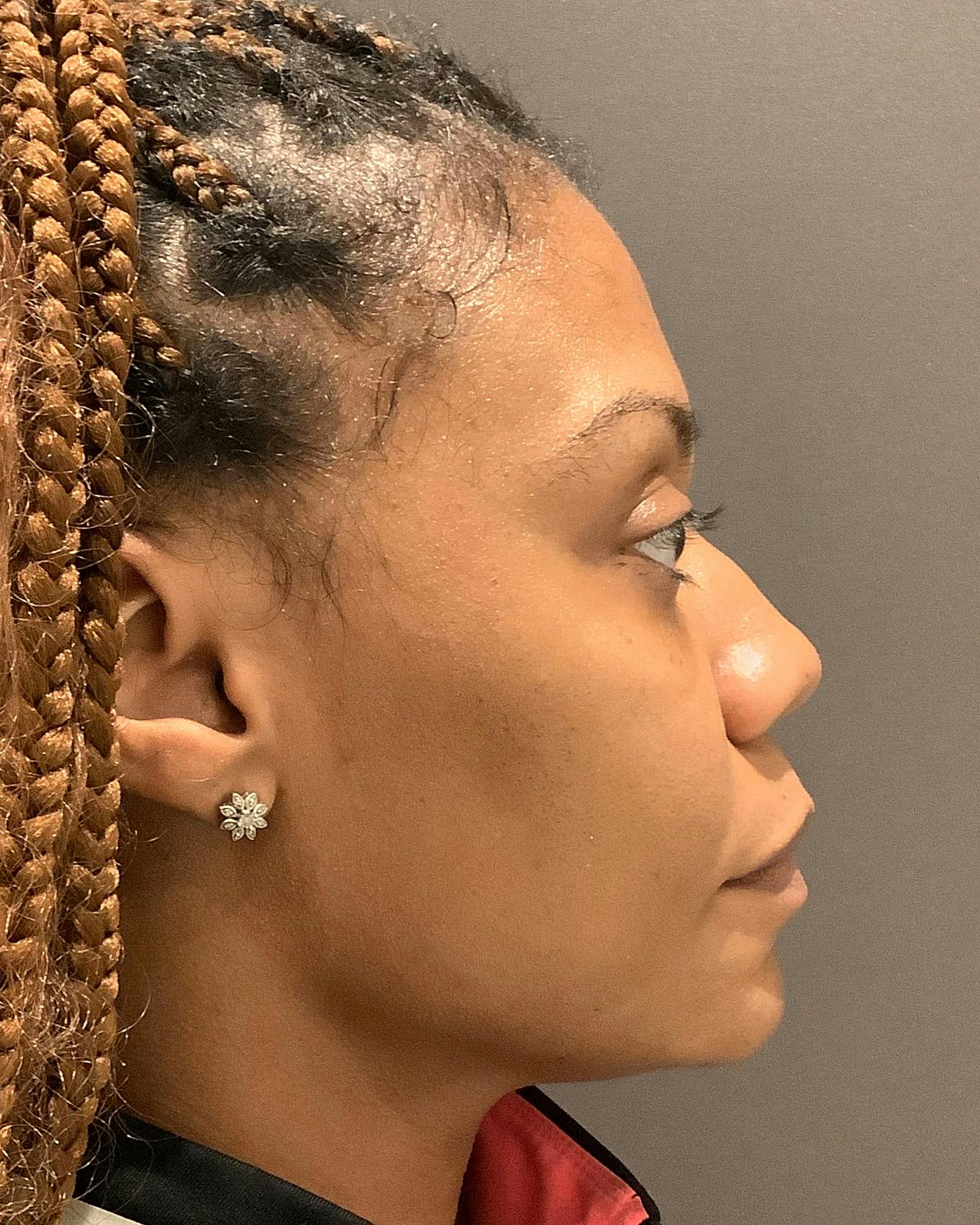 Rhinoplasty Before & After Gallery - Patient 245867 - Image 1