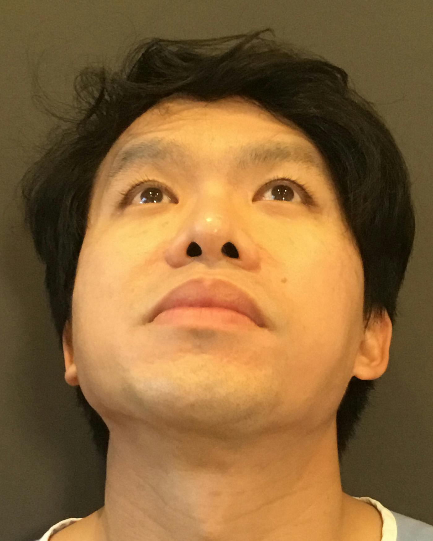 Revision Rhinoplasty Before & After Gallery - Patient 536784 - Image 9