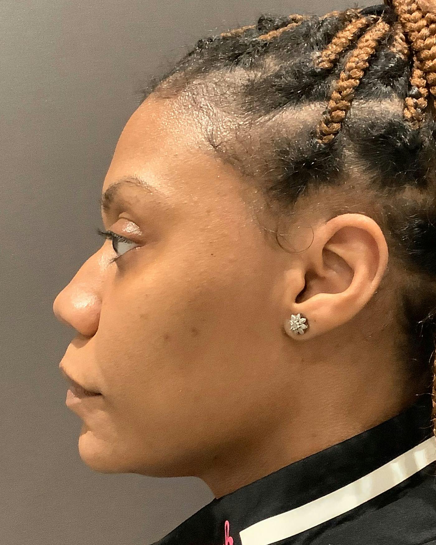 Rhinoplasty Before & After Gallery - Patient 245867 - Image 7