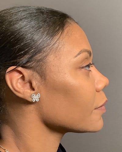 Rhinoplasty Before & After Gallery - Patient 245867 - Image 2