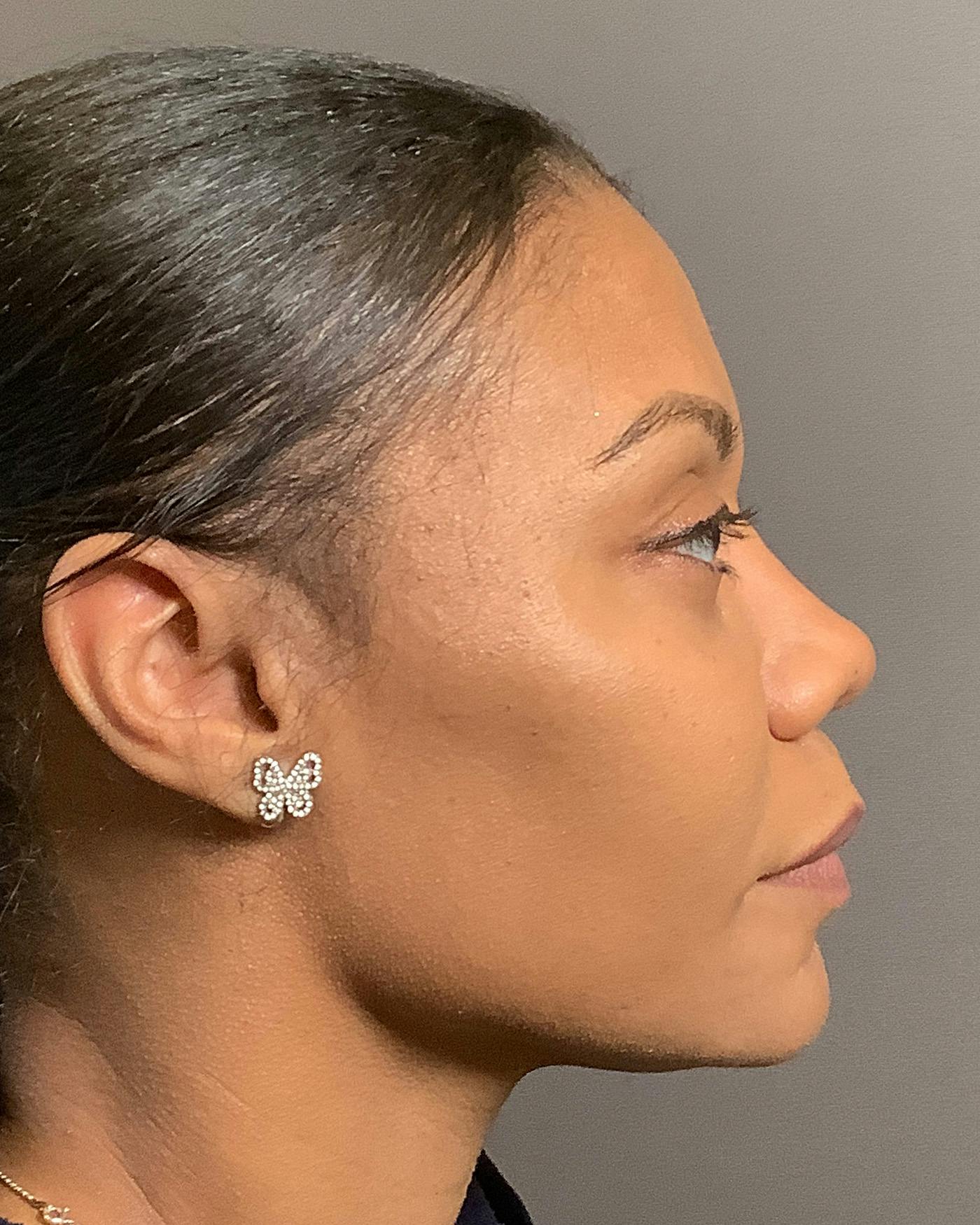 Rhinoplasty Before & After Gallery - Patient 245867 - Image 2