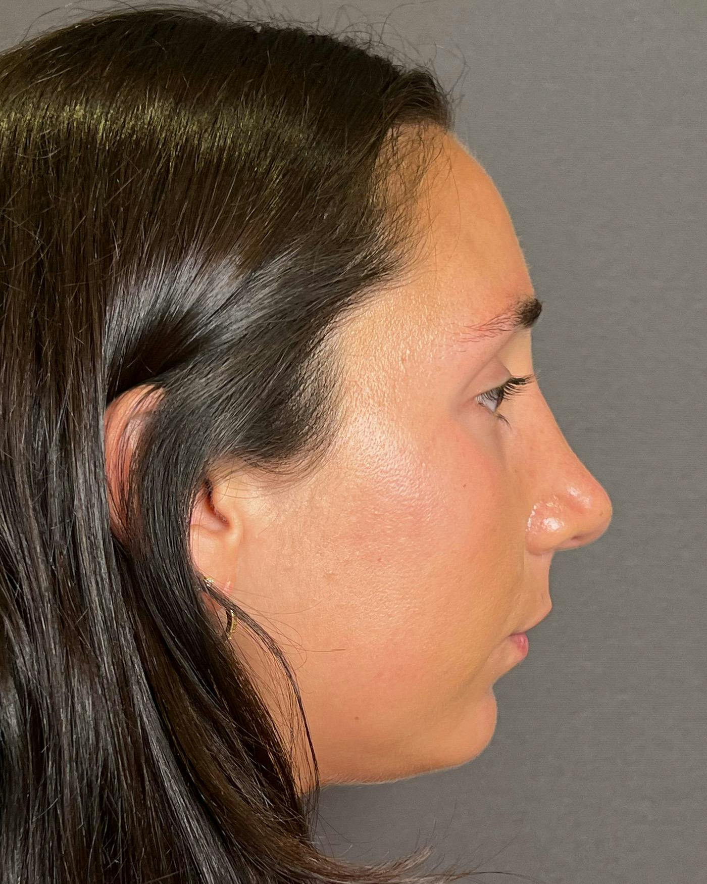 Rhinoplasty Before & After Gallery - Patient 295816 - Image 2
