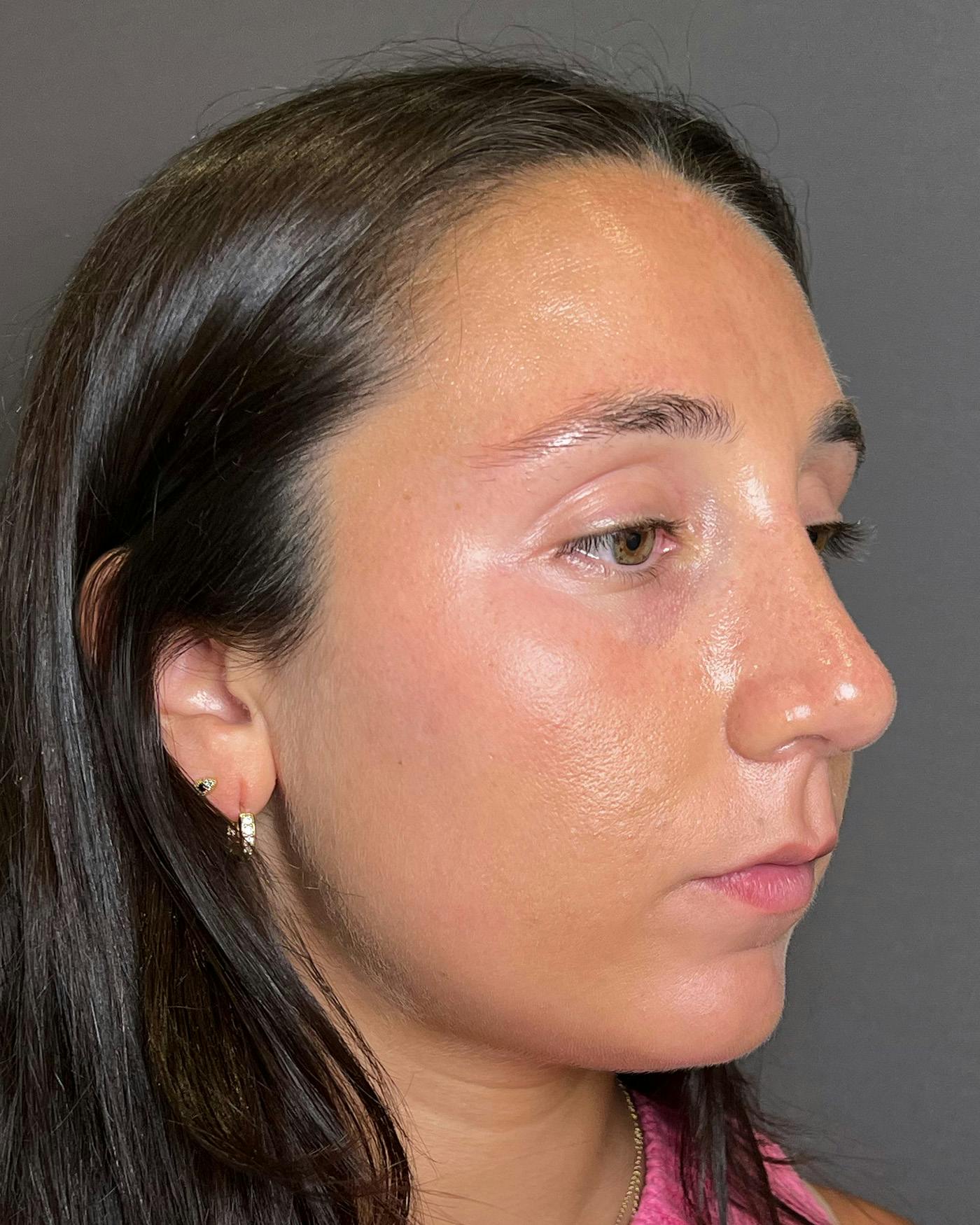 Rhinoplasty Before & After Gallery - Patient 295816 - Image 4