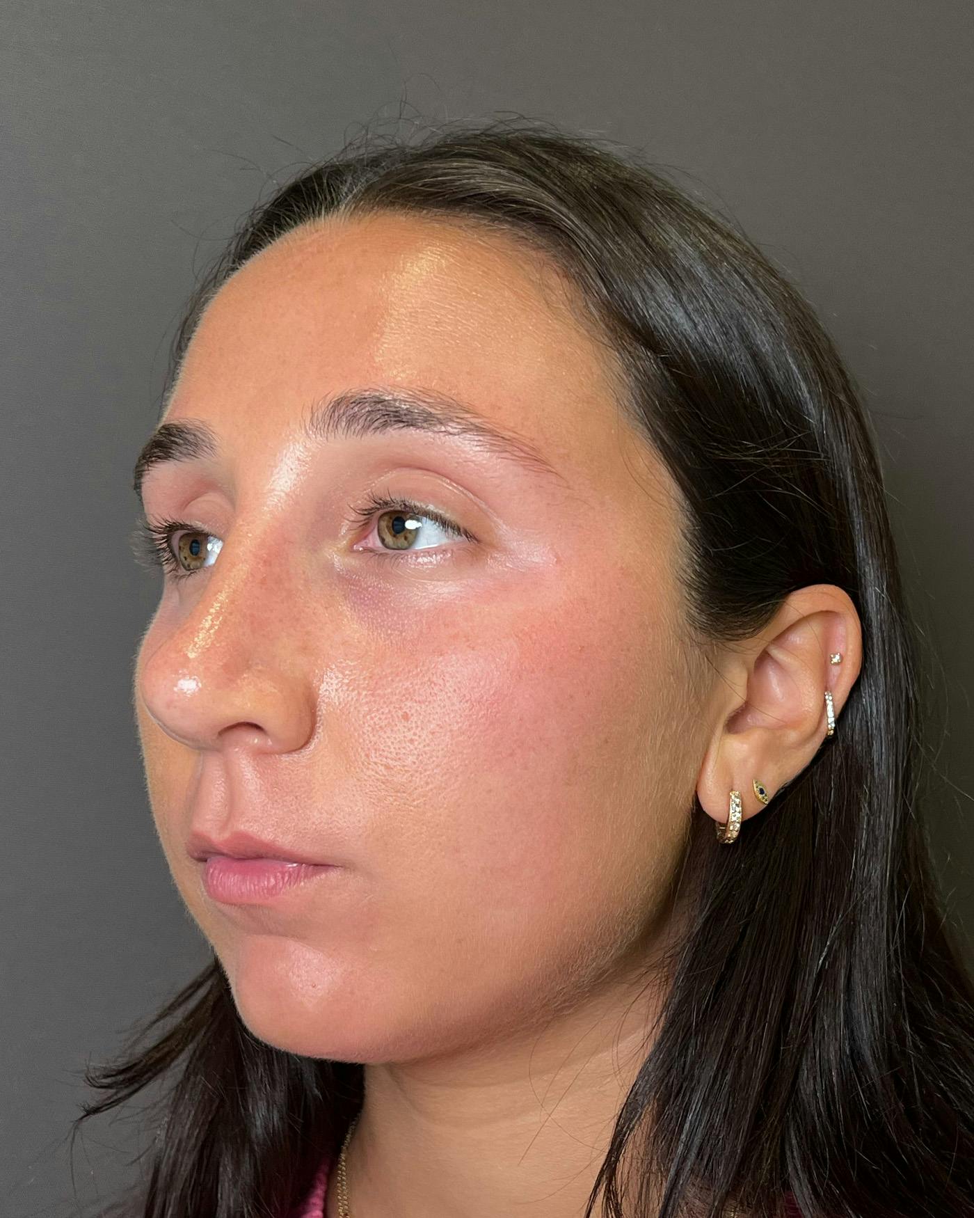 Rhinoplasty Before & After Gallery - Patient 295816 - Image 8