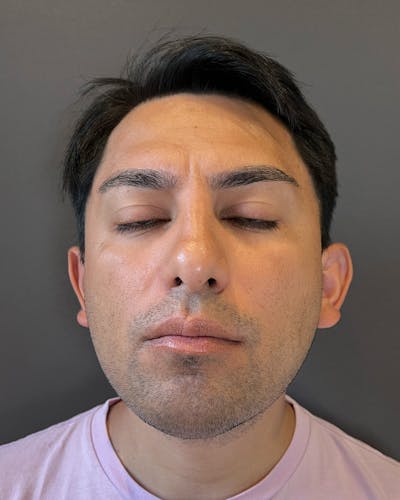 Liposuction Before & After Gallery - Patient 375667 - Image 1
