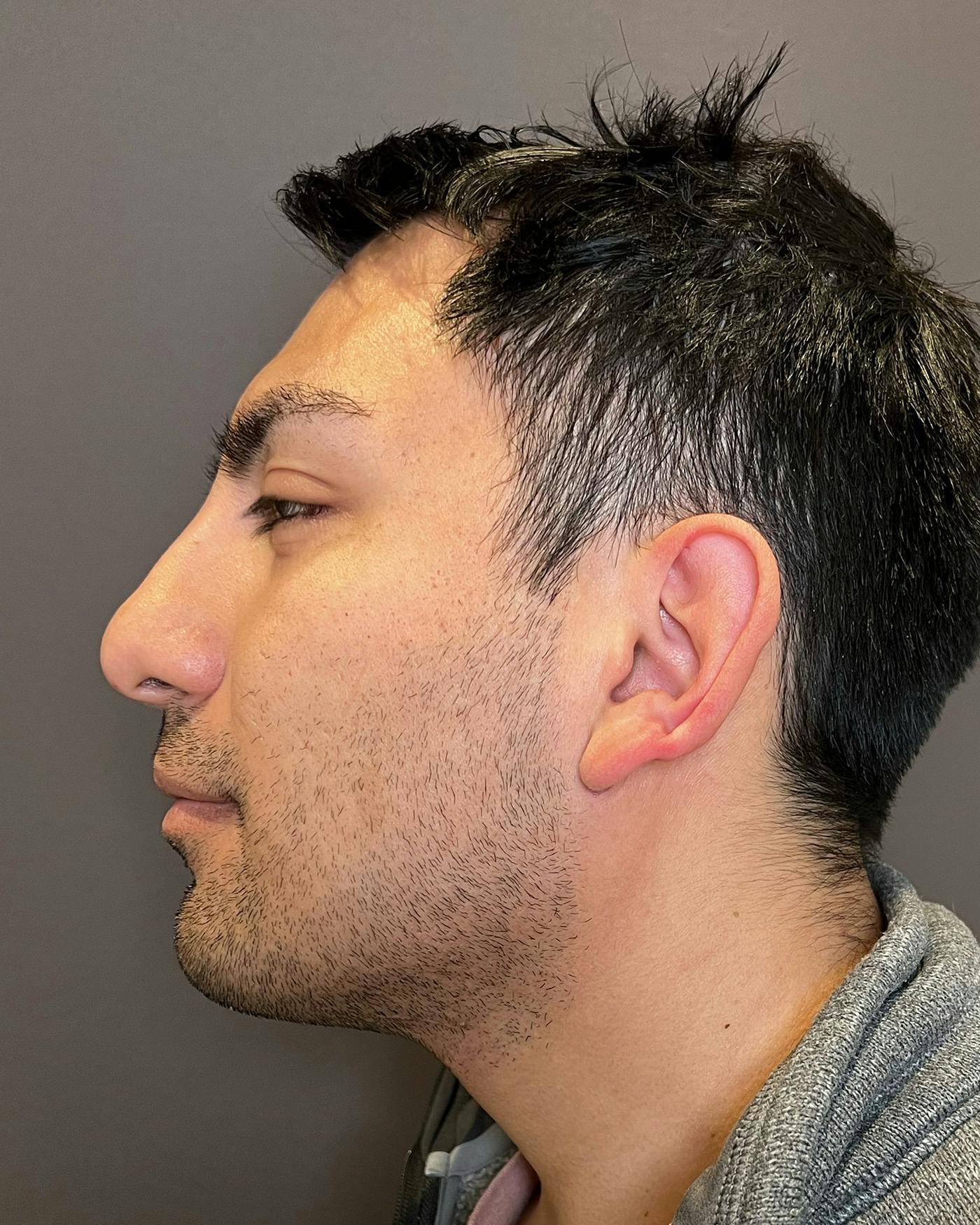 Liposuction Before & After Gallery - Patient 375667 - Image 10