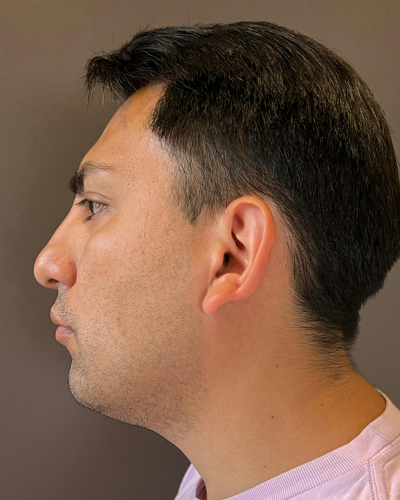 Liposuction Before & After Gallery - Patient 375667 - Image 9