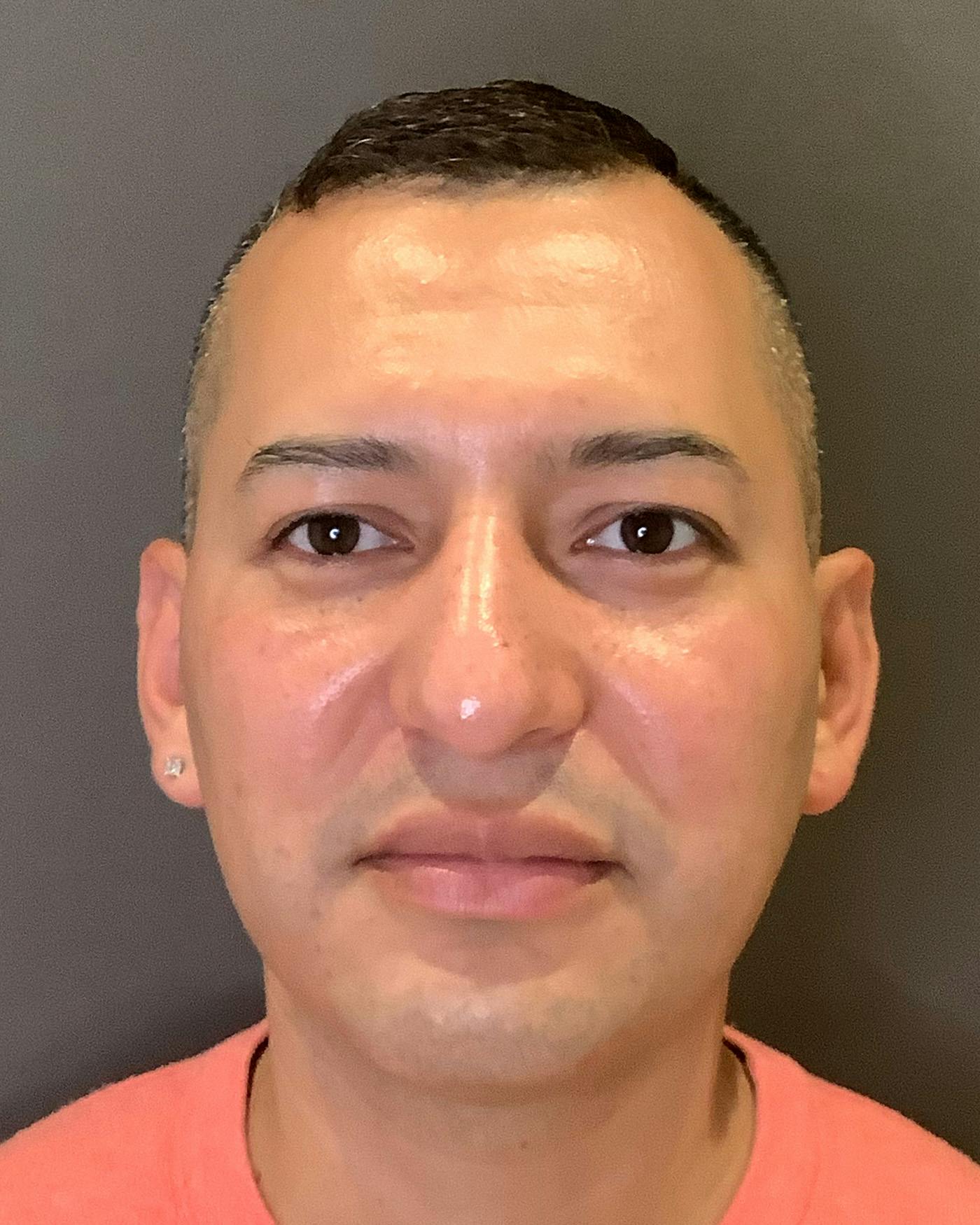 Rhinoplasty Before & After Gallery - Patient 748574 - Image 5