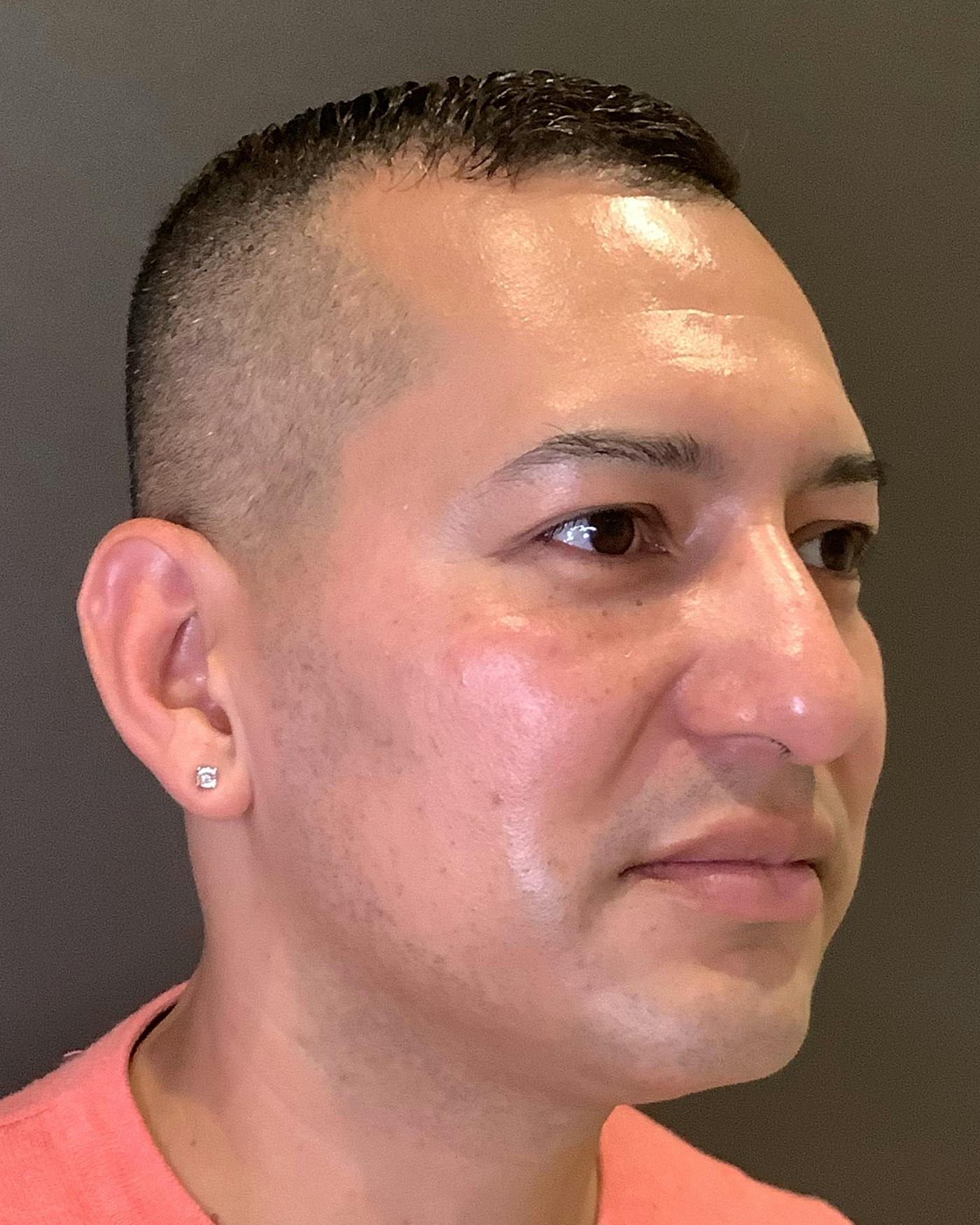 Rhinoplasty Before & After Gallery - Patient 748574 - Image 3