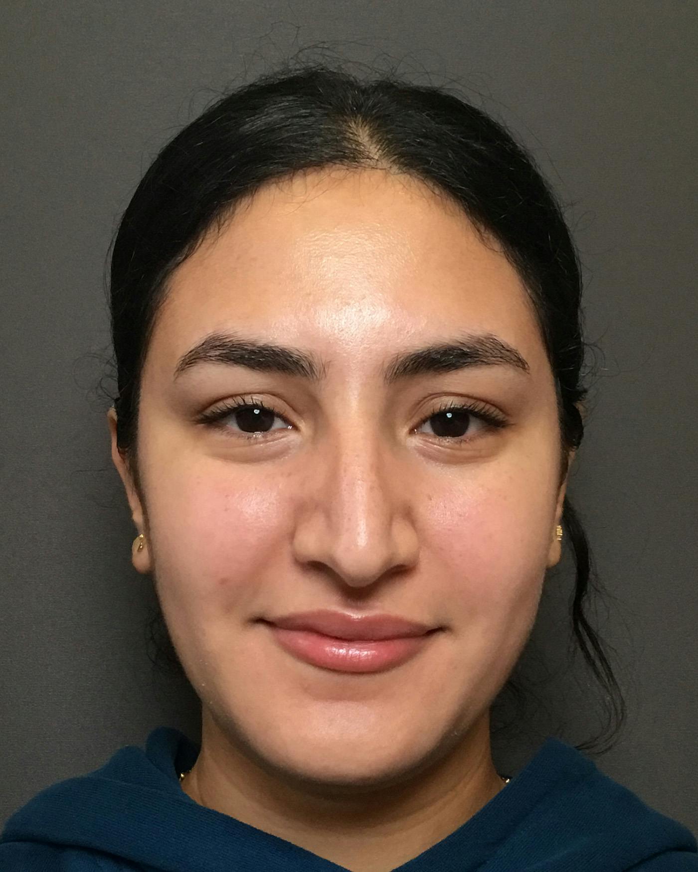 Rhinoplasty Before & After Gallery - Patient 403059 - Image 5