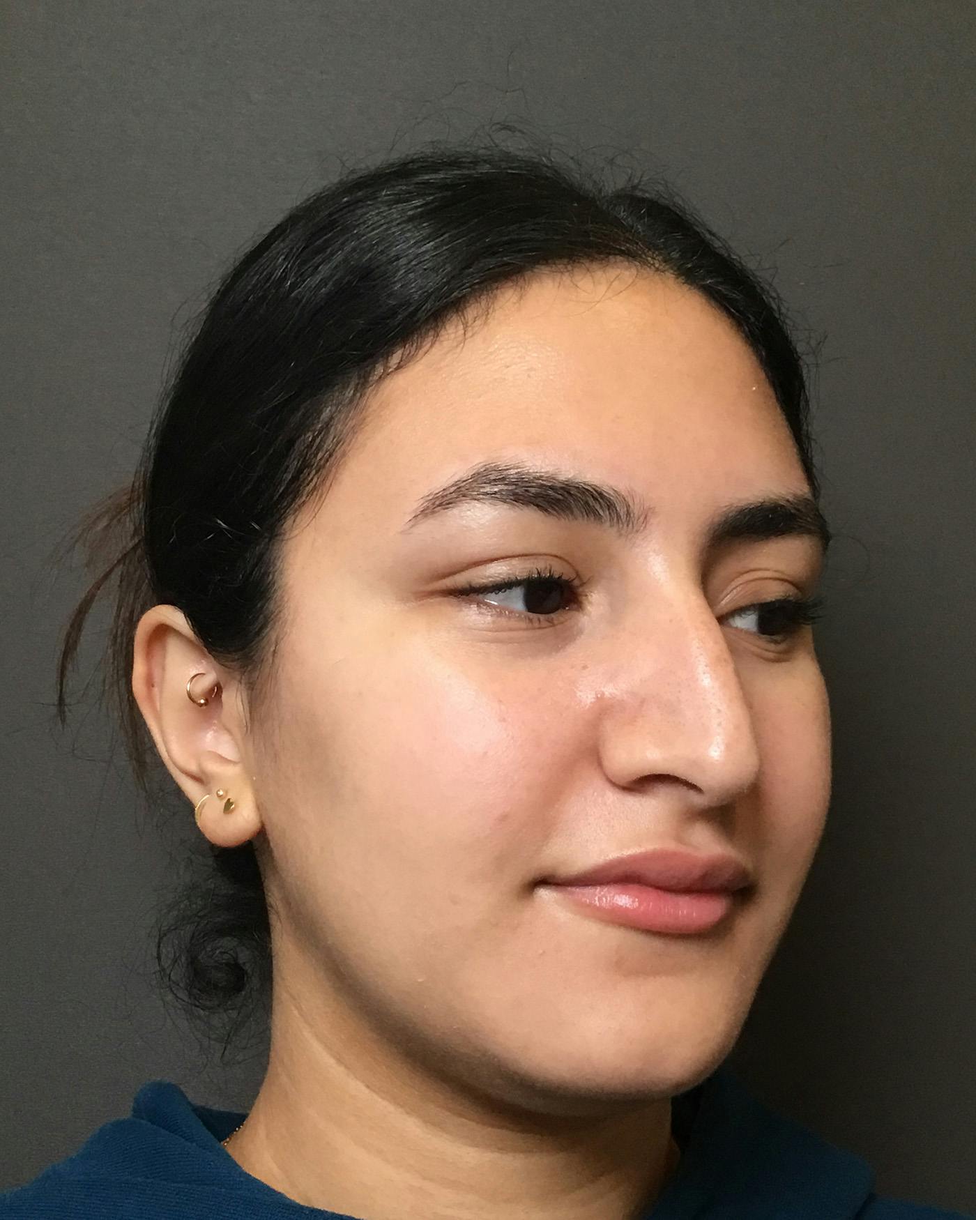 Rhinoplasty Before & After Gallery - Patient 403059 - Image 3