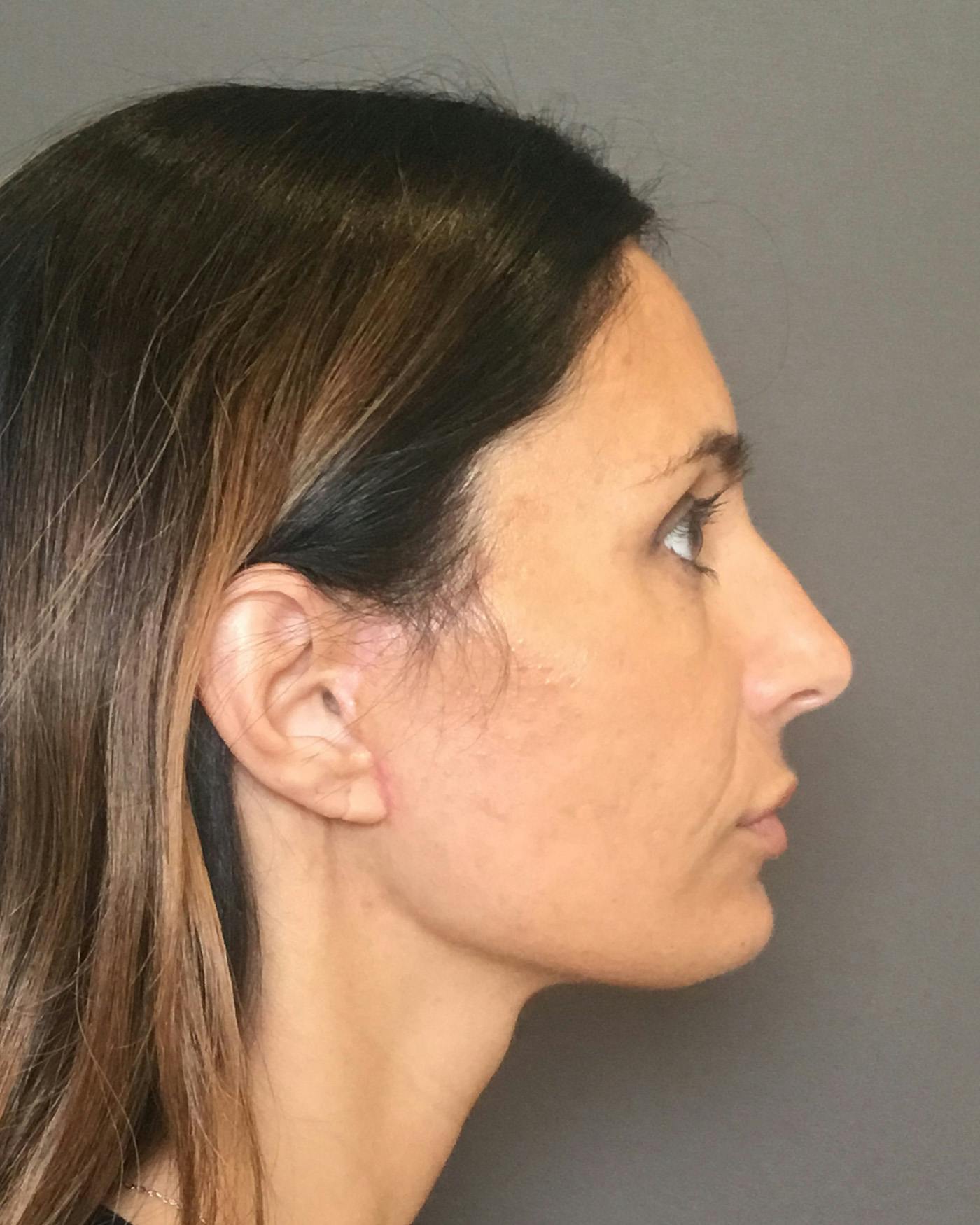 Facelifts / Necklift Before & After Gallery - Patient 400757 - Image 4