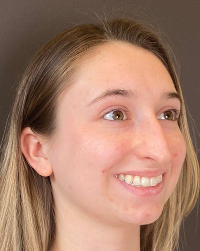 Rhinoplasty Before & After Gallery - Patient 184956 - Image 1