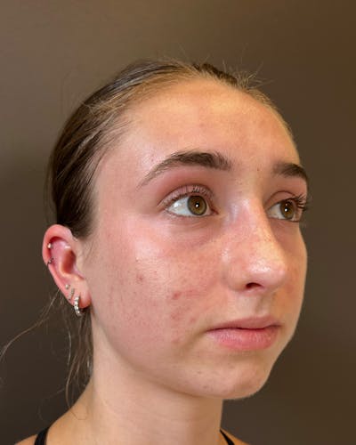 Rhinoplasty Before & After Gallery - Patient 184956 - Image 2