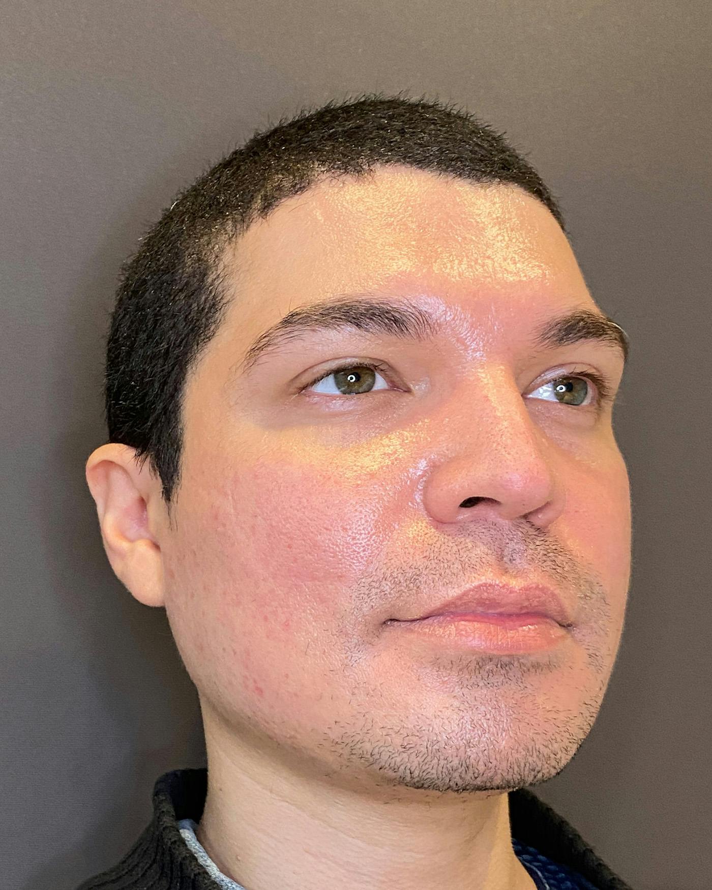 Rhinoplasty Before & After Gallery - Patient 169027 - Image 3