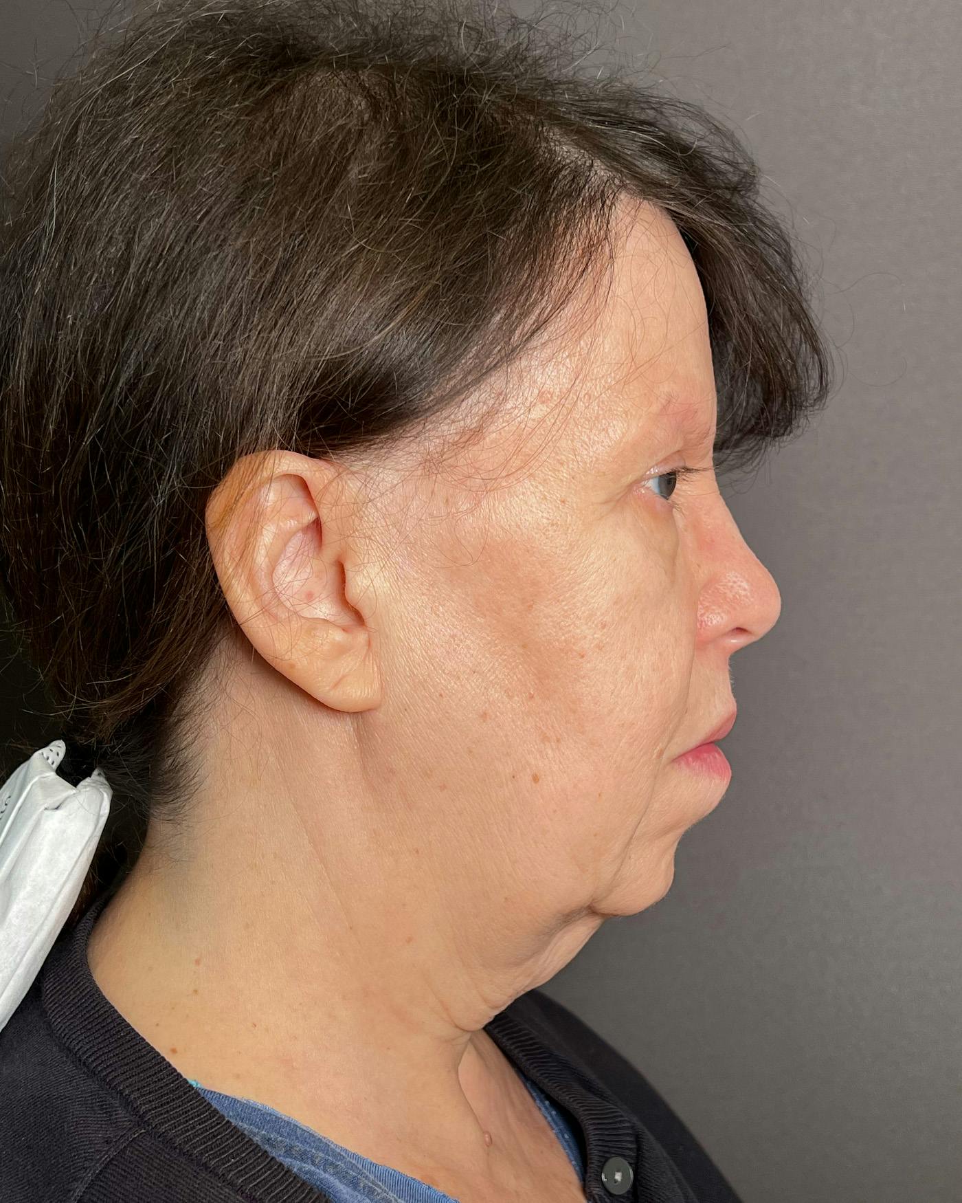 Facelifts / Necklift Before & After Gallery - Patient 183402 - Image 3