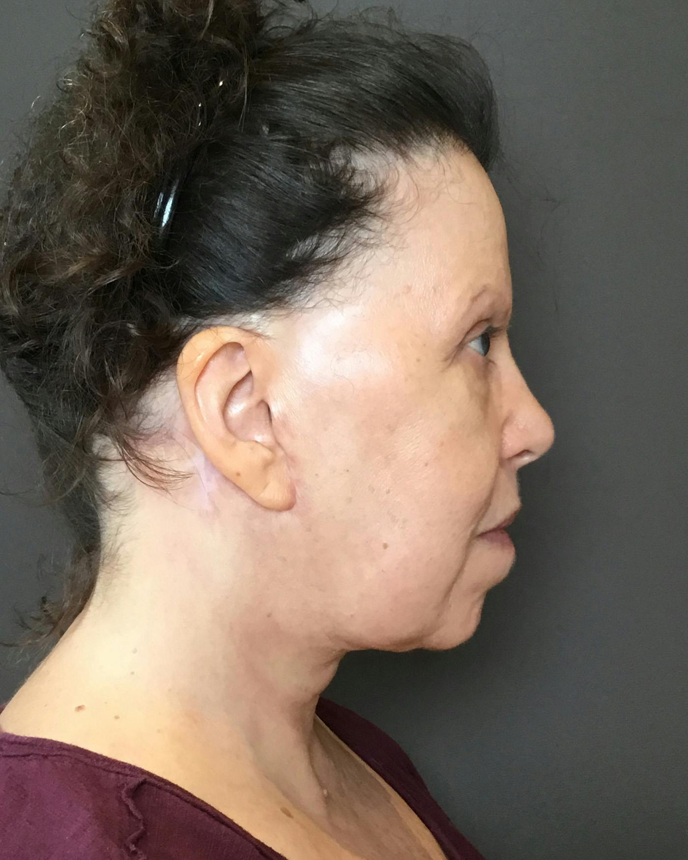 Facelifts / Necklift Before & After Gallery - Patient 183402 - Image 4