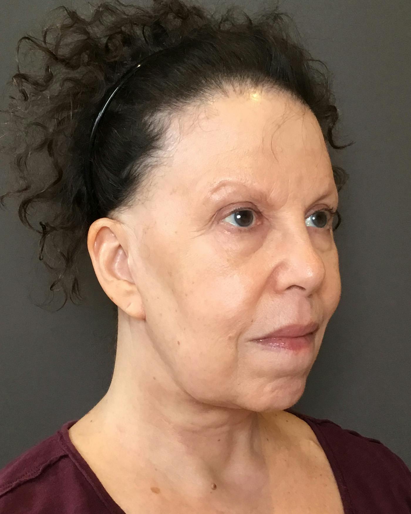 Top Surgery Before & After Gallery - Patient 149616 - Image 4