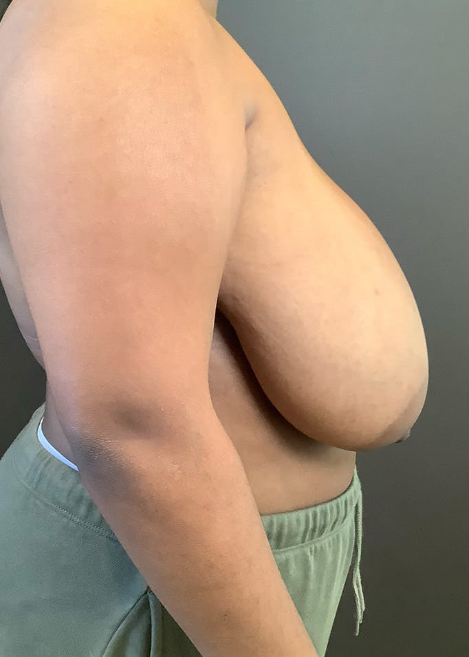 Breast Reduction Before & After Gallery - Patient 393984 - Image 5