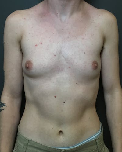 Top Surgery Before & After Gallery - Patient 149616 - Image 1