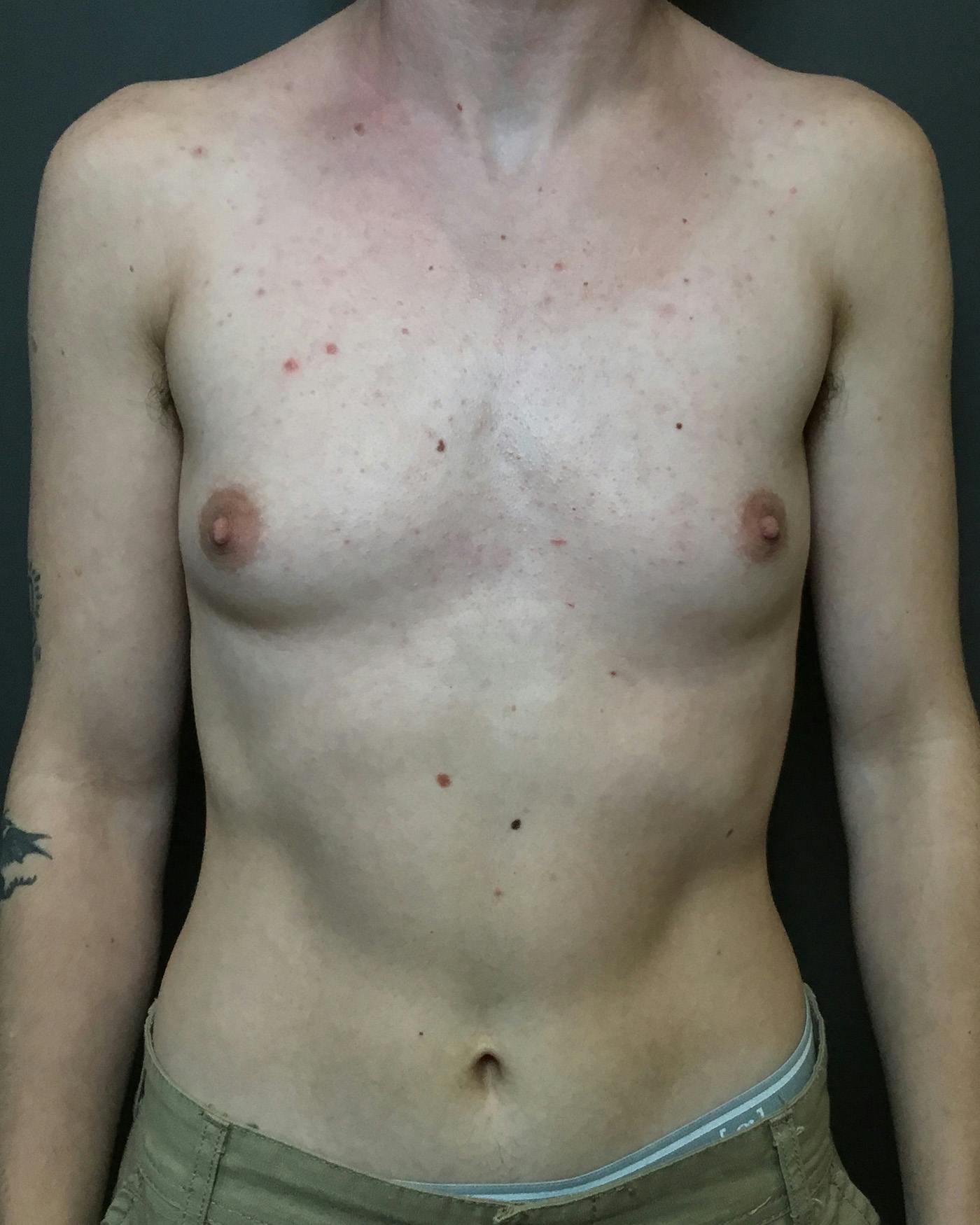 Top Surgery Before & After Gallery - Patient 149616 - Image 1