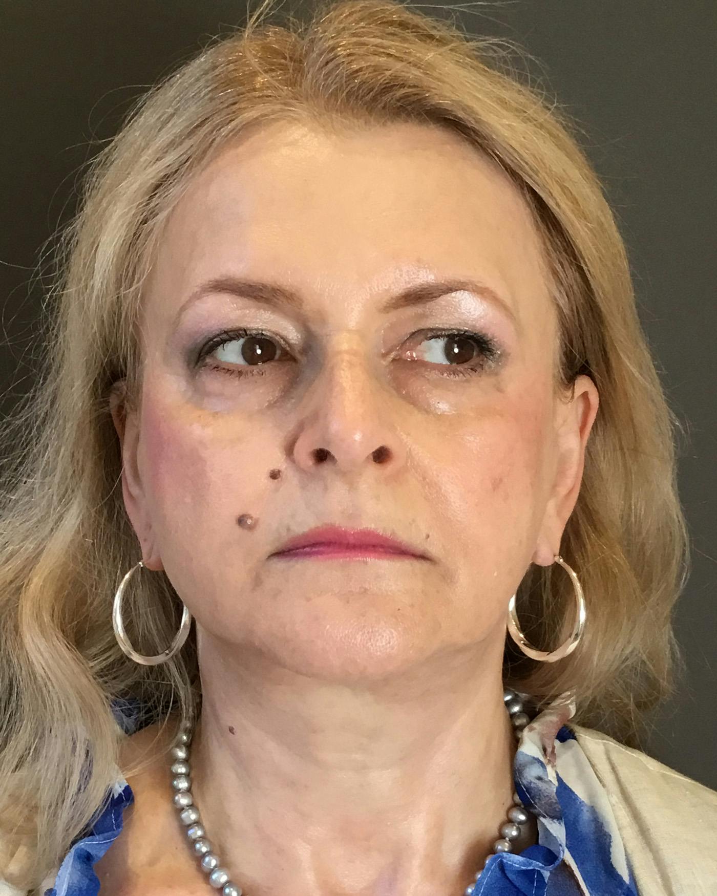 Facelifts / Necklift Before & After Gallery - Patient 737281 - Image 6