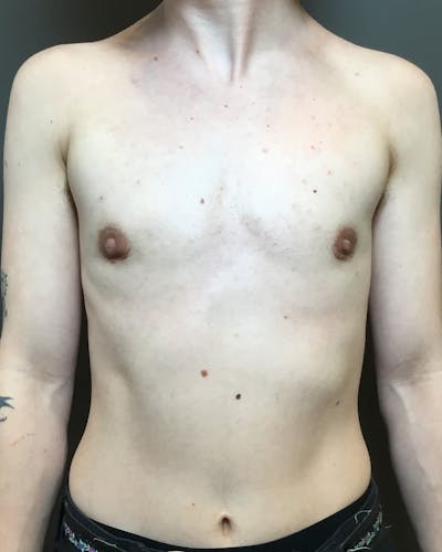 Top Surgery Before & After Gallery - Patient 149616 - Image 2