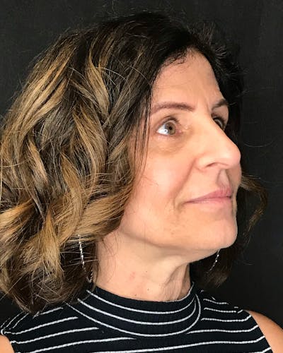 Facelifts / Necklift Before & After Gallery - Patient 208221 - Image 1