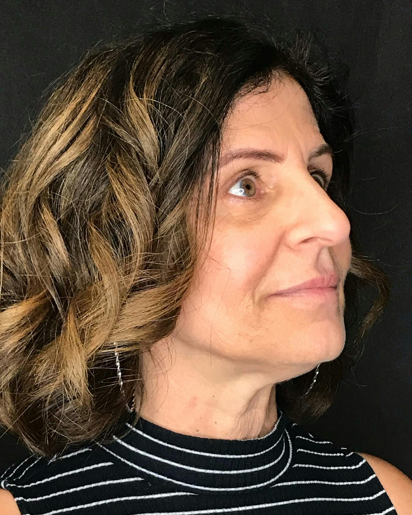 Facelifts / Necklift Before & After Gallery - Patient 208221 - Image 1