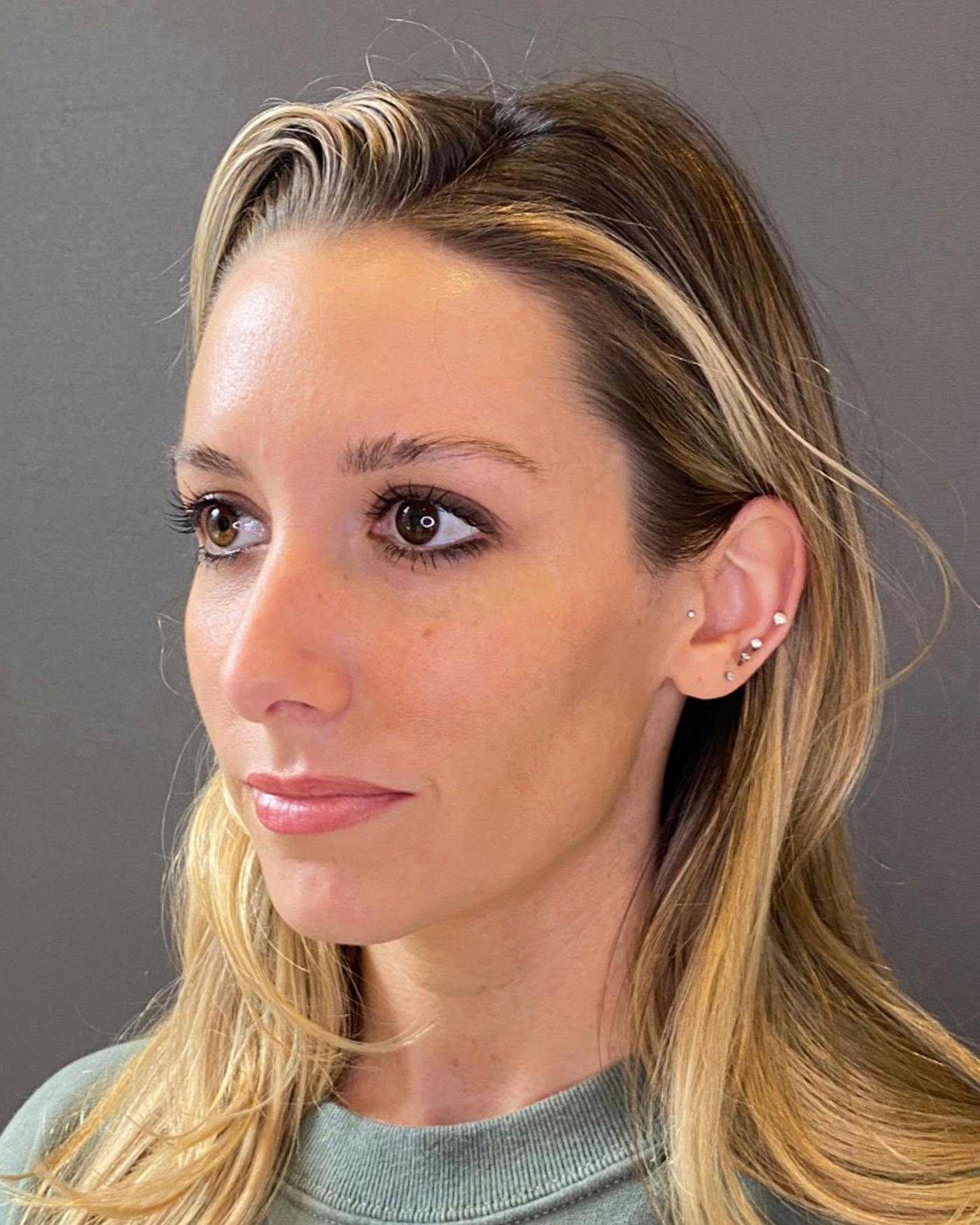 Rhinoplasty Before & After Gallery - Patient 263581 - Image 9